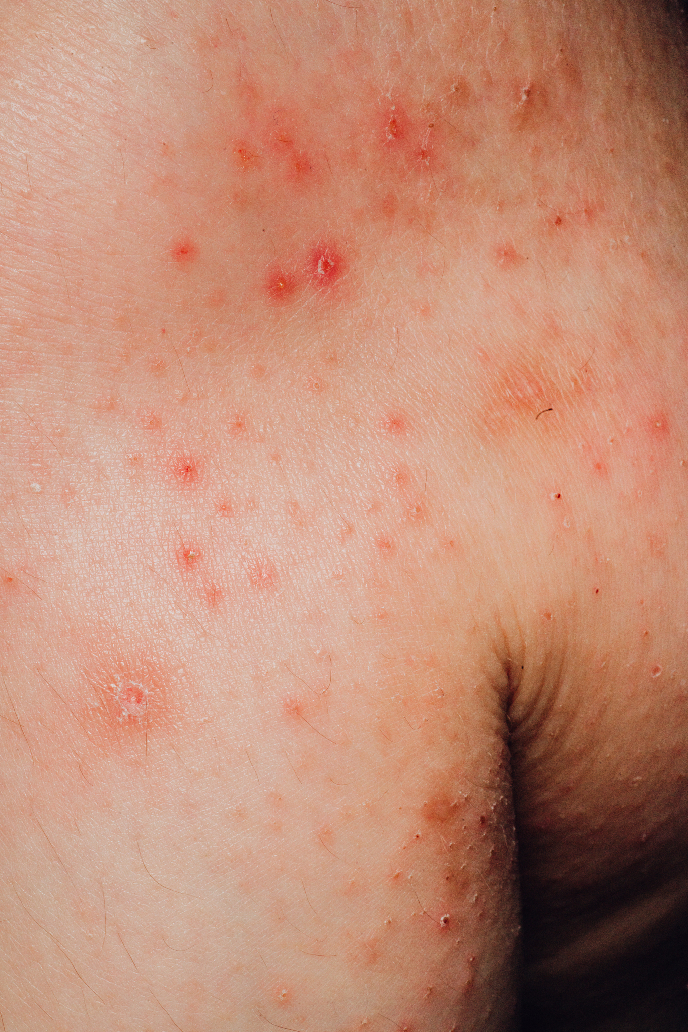 快速止痒方法大全：7招有效缓解皮肤瘙痒