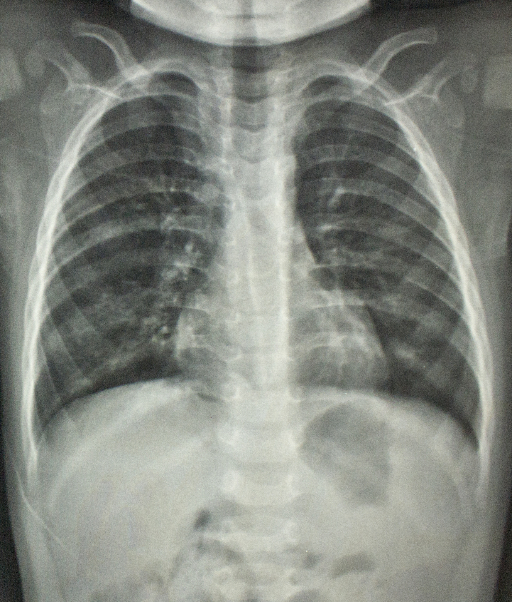 CT 图像灰度与诊断：直接观察靠谱吗？