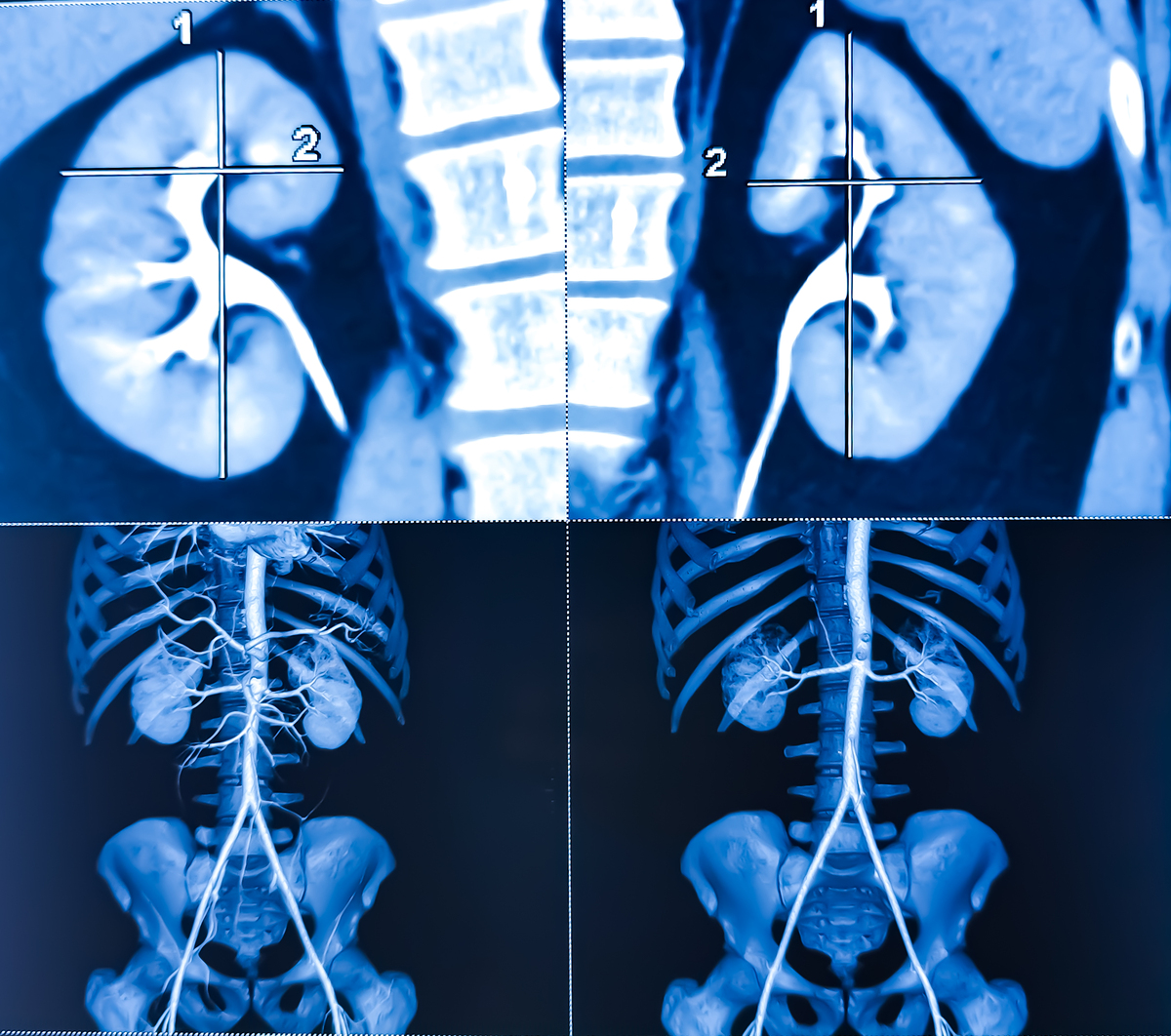 请根据以下语言生成一张流程图：1对术前CT影像进行3D建模得到腰椎的虚拟3D模型；2术中拍摄腰椎侧位X线片；3设置初始转换参数；确定 X 射线图像和 CT 数据之间相对位姿的初始猜测以进行优化；4将步骤1得到的腰椎虚拟3D模型采用光线追踪技术用点光源进行投影根据初始变换参数得到侧位的DRR图像；5使用模式强度算法对DRR图像和术中侧位X射线图像进行相似度计算；6如果相似度计算结果符合标准则可以完成