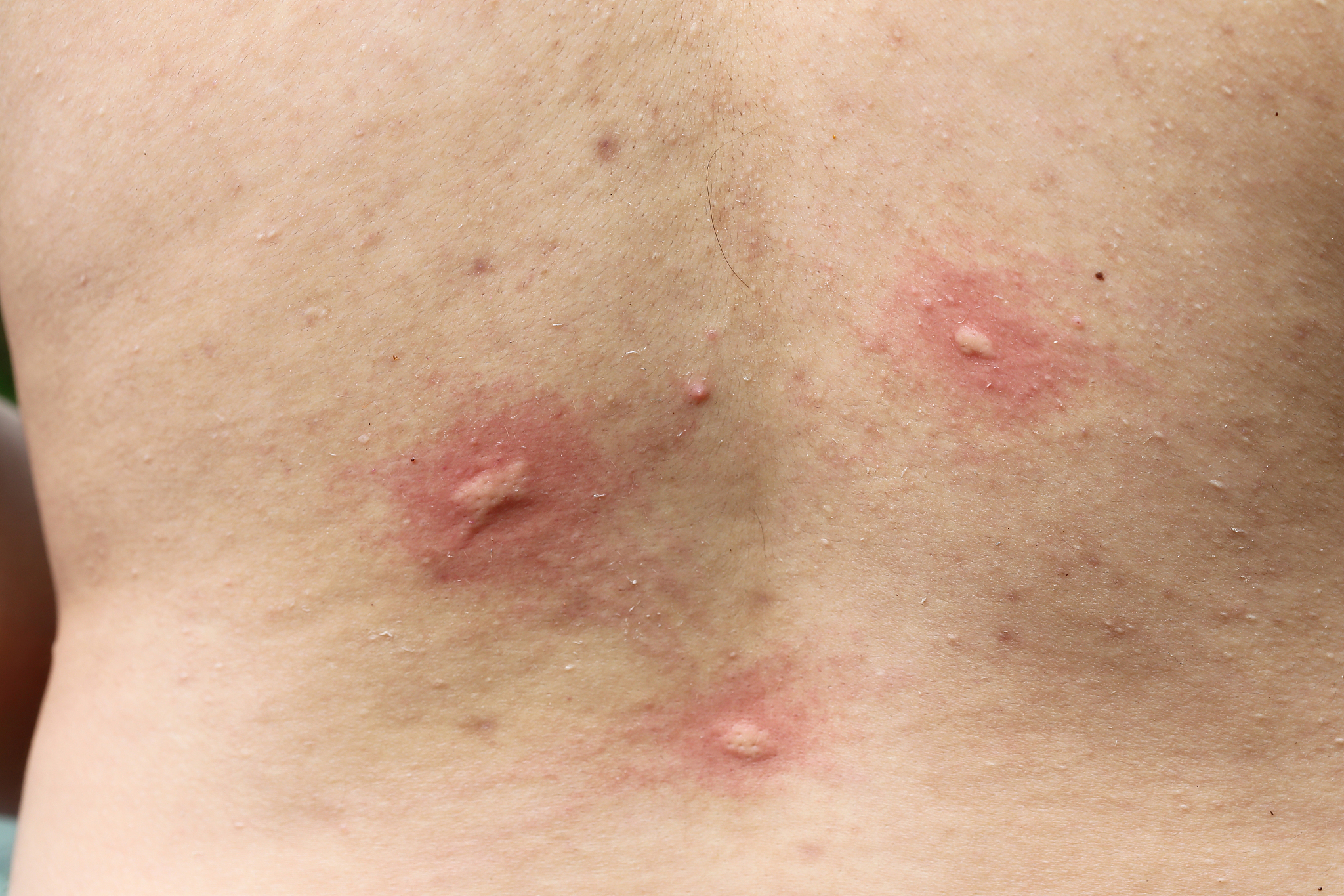 multiple mosquito bites on body