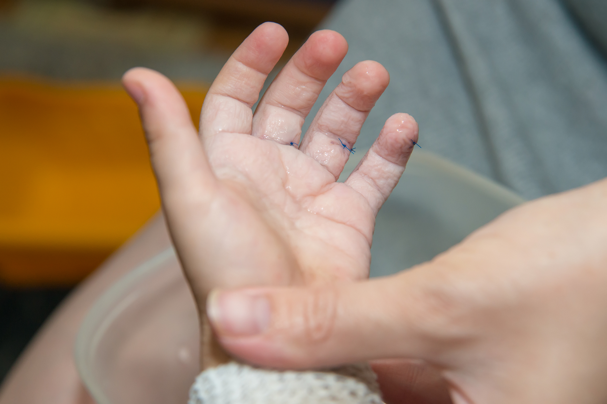 参军体检手指畸形鉴定标准帮我用200字详细描述