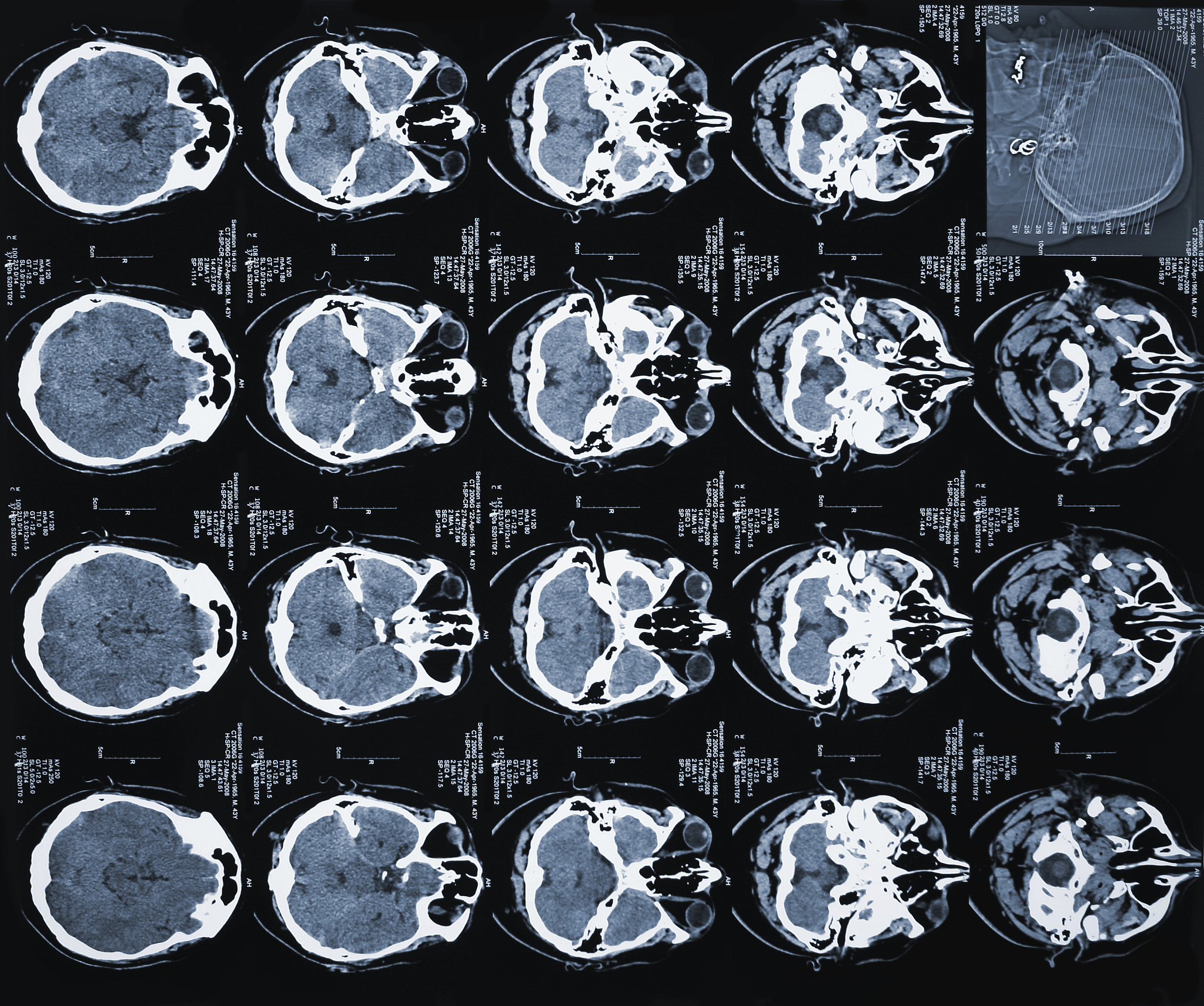 面部ct图数据集