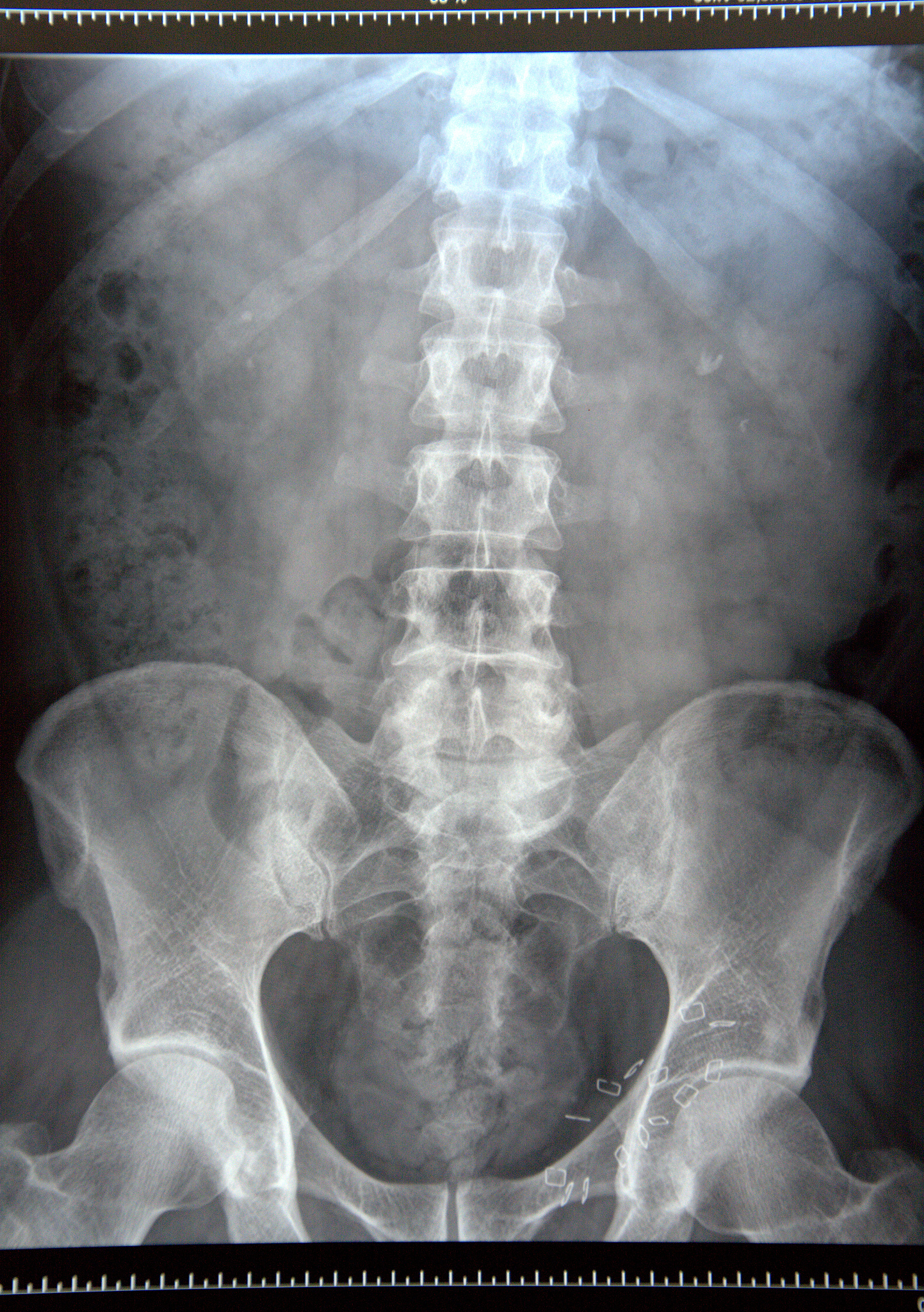 泌尿系结石科普：成因、症状、治疗和预防