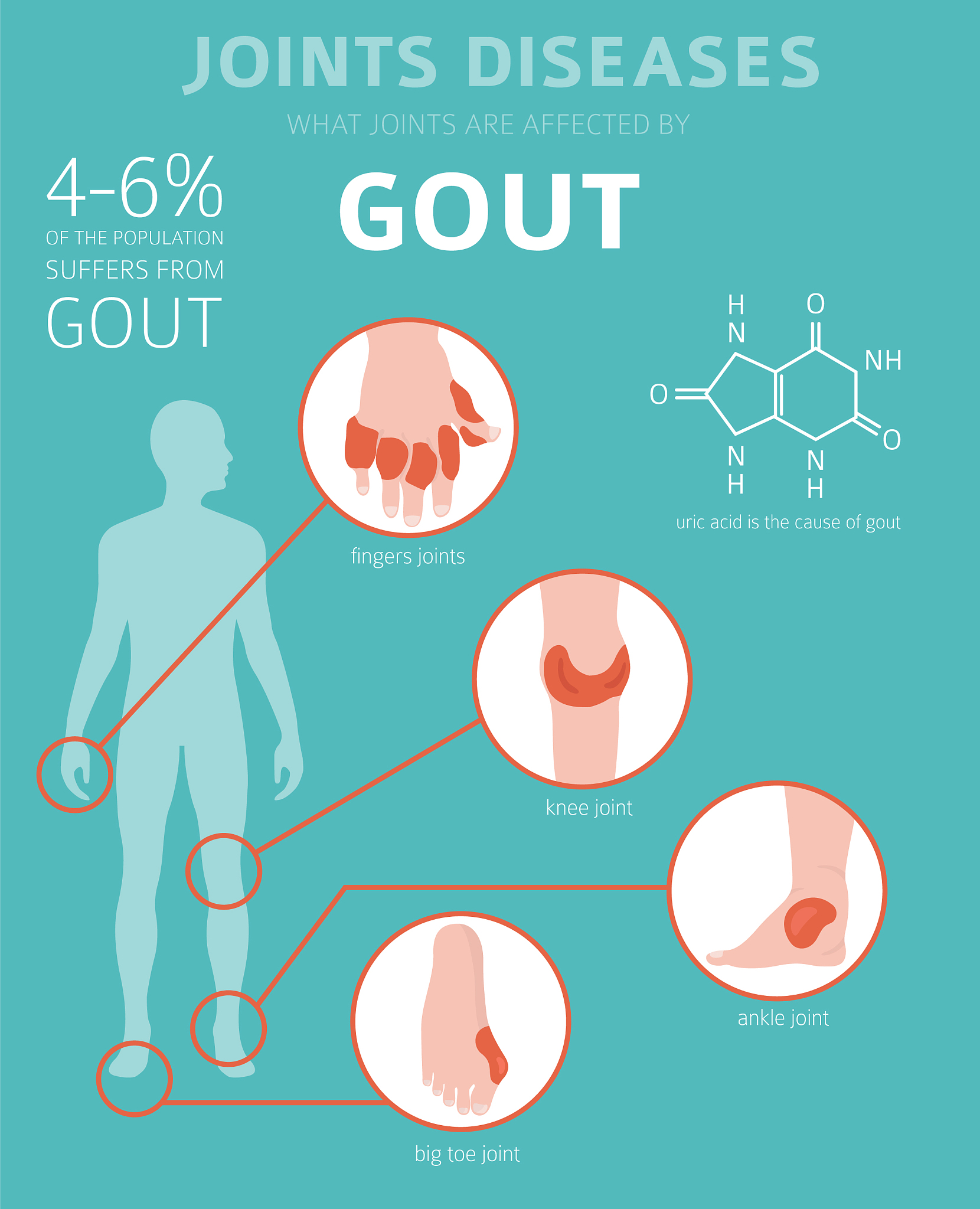 痛风应该怎么治疗注意什么