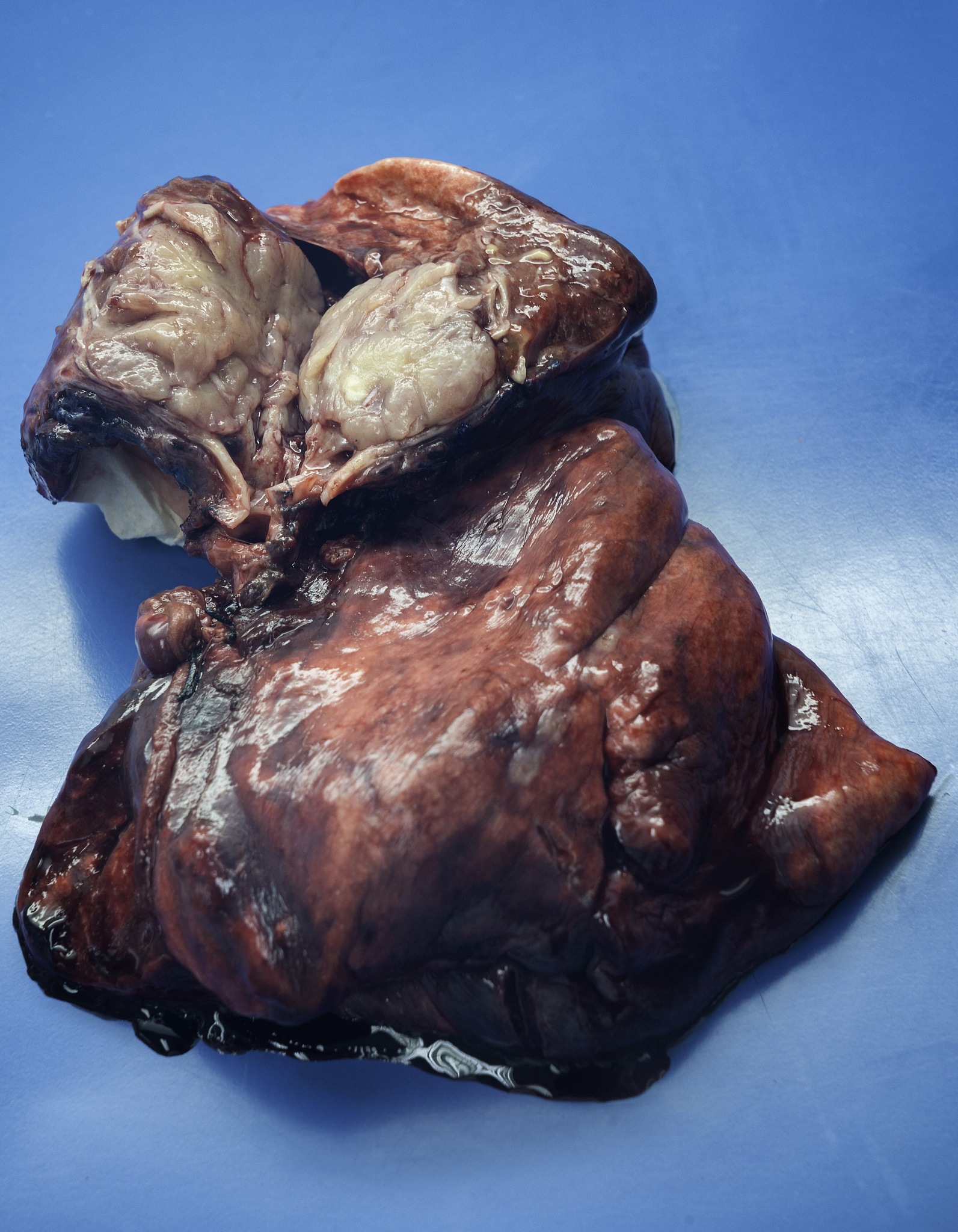 右肺上叶肿瘤：类型、症状、诊断与治疗方法