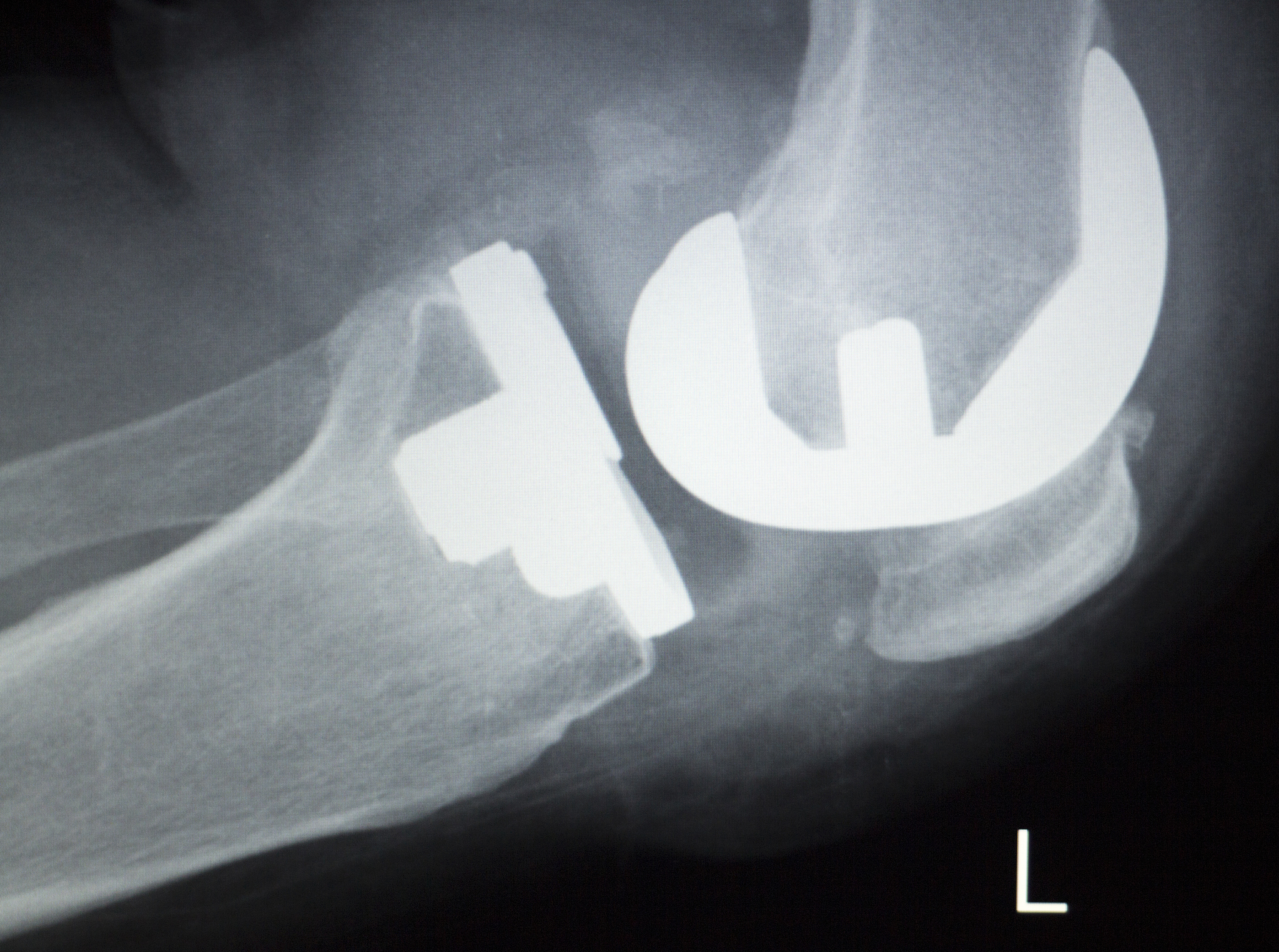 老年人腰椎间盘突出科普：症状、原因、治疗及预防