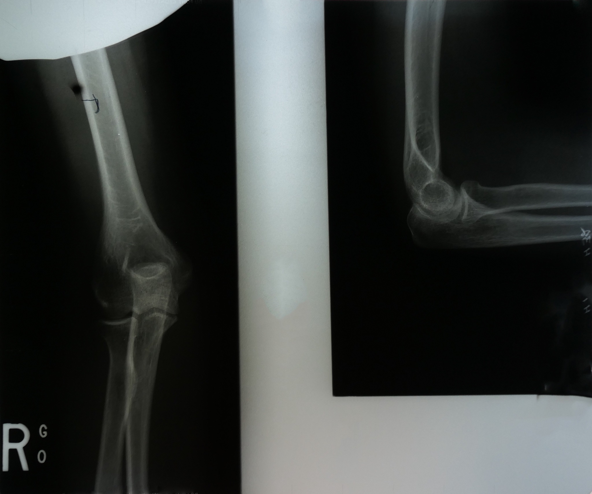 骨盆骨折合并失血性休克手术：C臂X光透视的应用