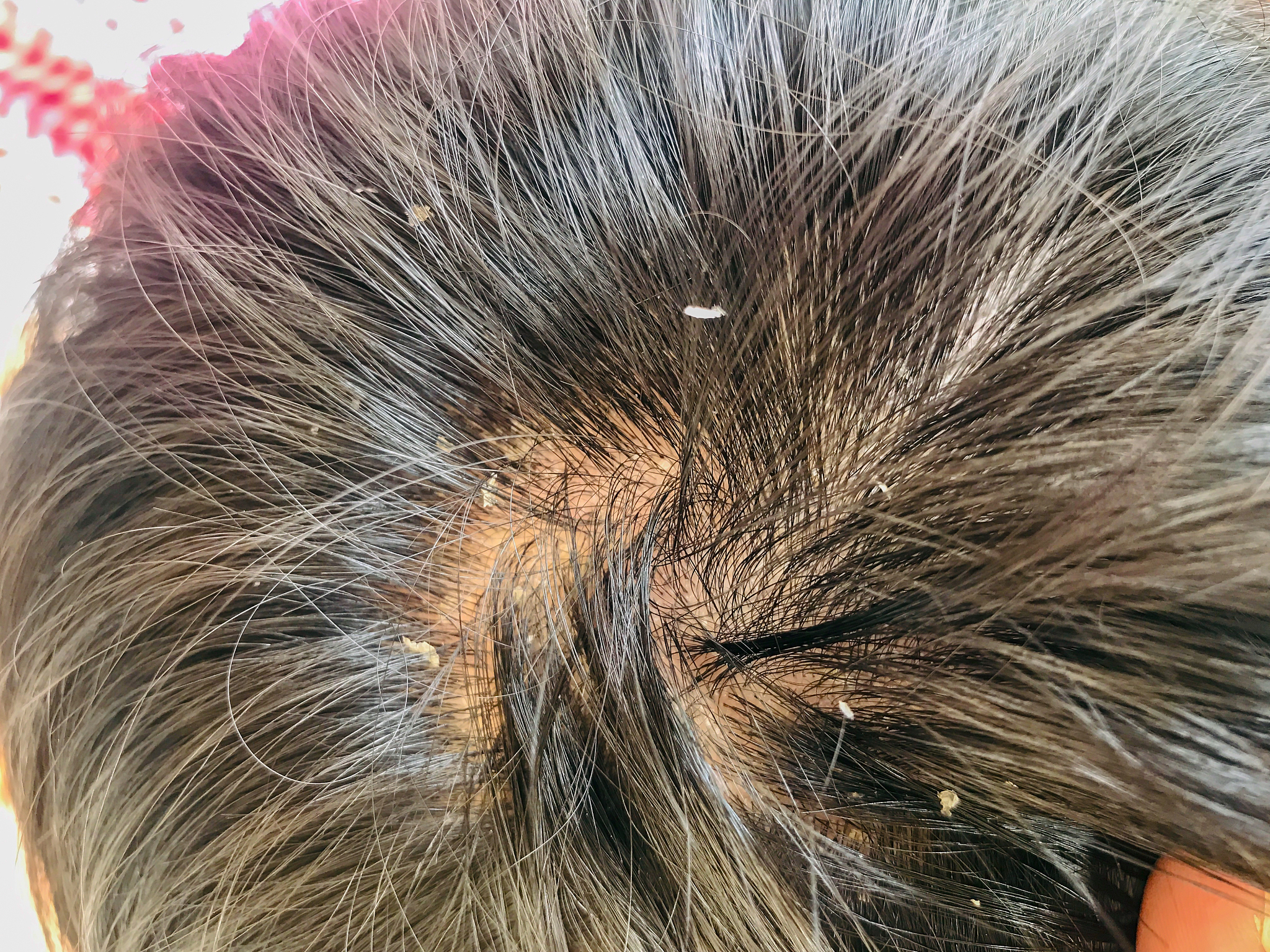 手一碰头发头皮就疼