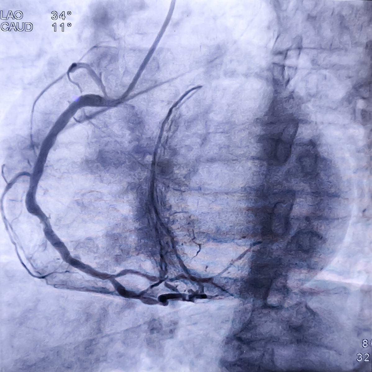 肺动脉造影术和肺动脉扩张术：国内技术水平与国际比较
