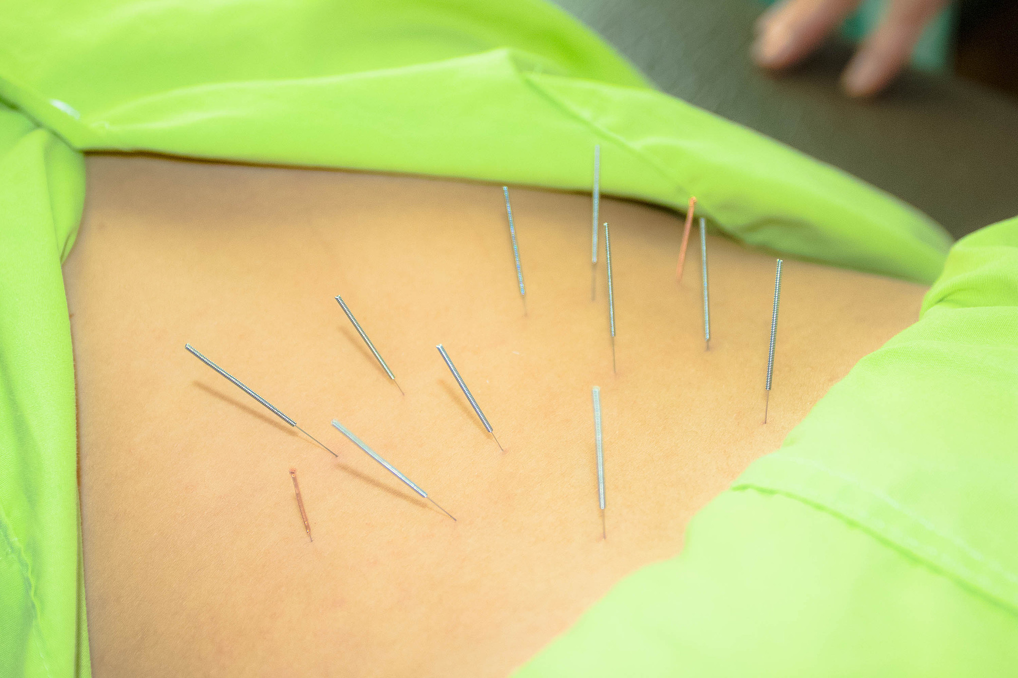 high angle view of human back with acupuncture needle
