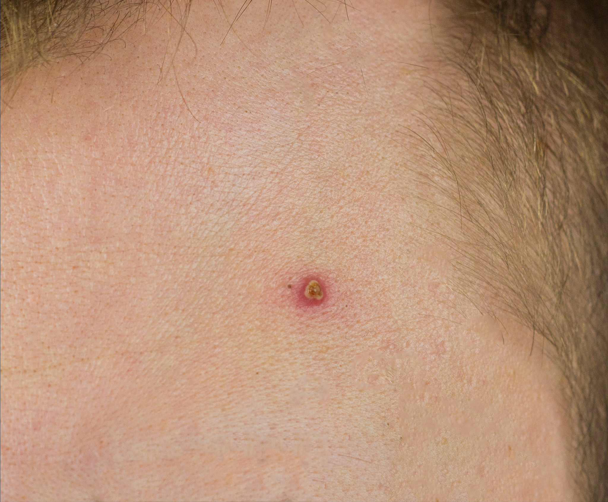 red pimple on the forehead of a man, close-up