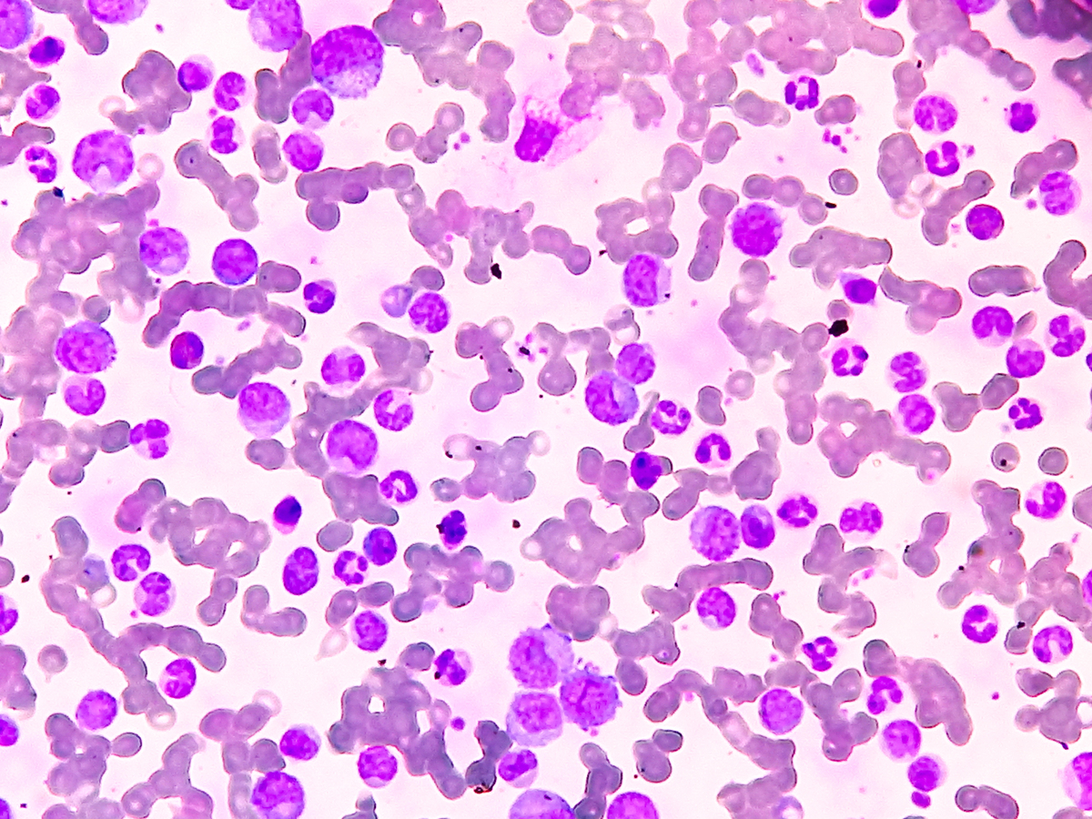 急性淋巴细胞白血病不治疗会怎样？后果很严重！