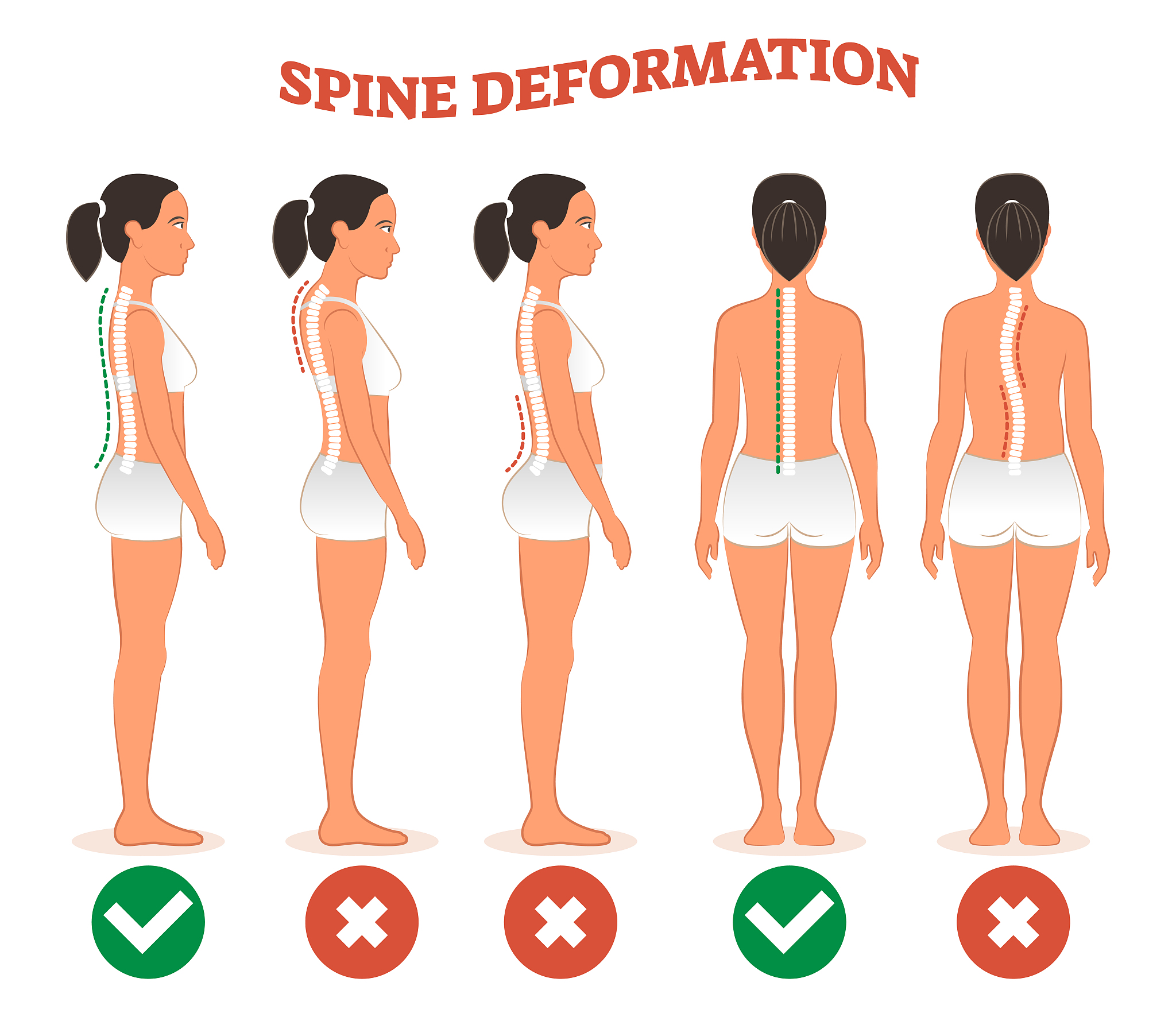 骨骼闭合后长高案例，