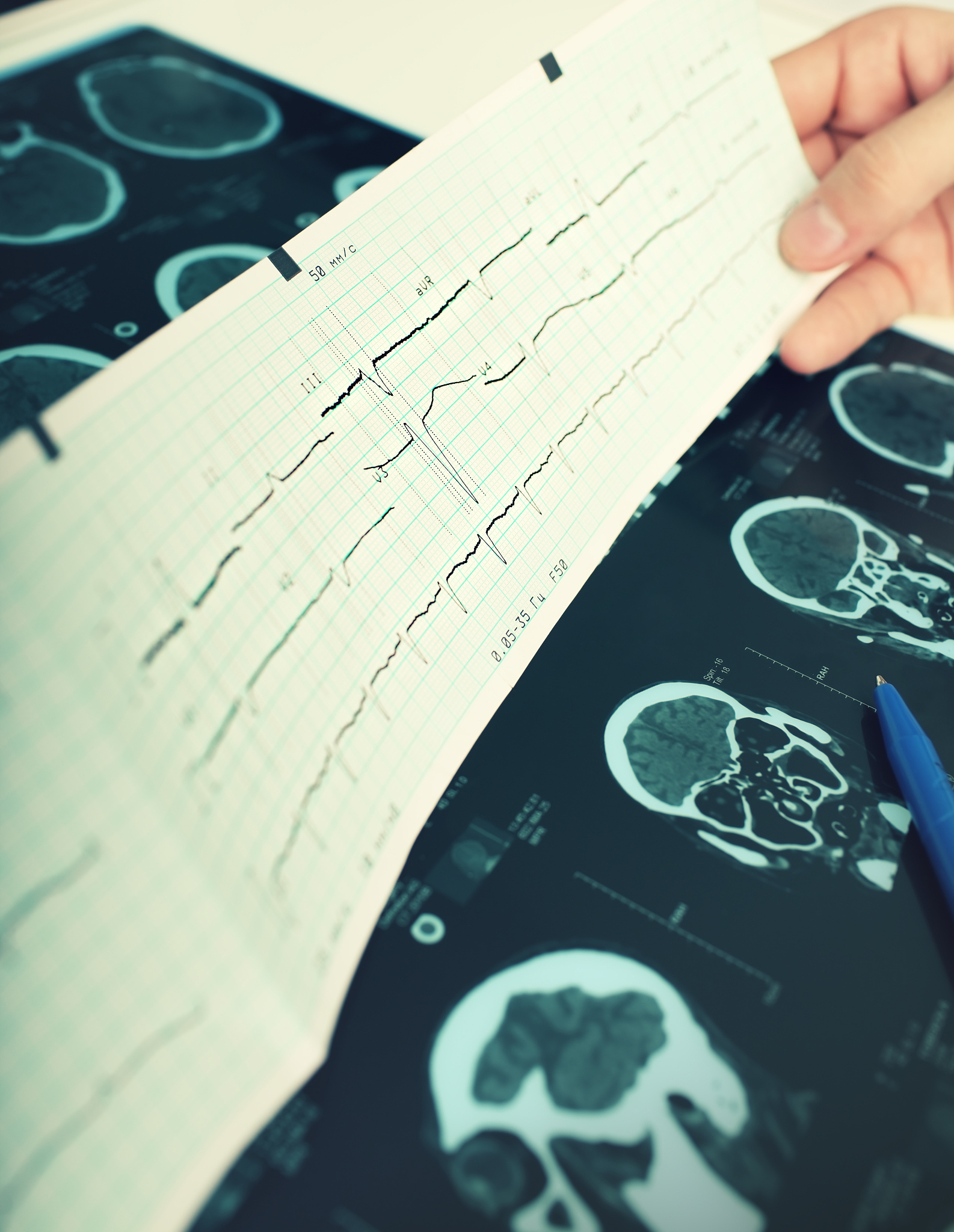 2019-09-27出生半岁前没发现什么异常只是发育迟缓个头动作语言如同3个月查血常规生化血气肝肾功能电解质均正常唯一异常的甲状腺功能T3稍高Tsh稍低我们张华主任说没什么诊断意义去多处看也诊断不清楚考虑脑瘫从怀孕到出生一直顺利一直康复锻炼到现在症状加重反复多次抽血末见异常腰椎骨盆平片正常头颅十胸椎十腰椎MR未见异常基因染色体查3次也末发现问题。