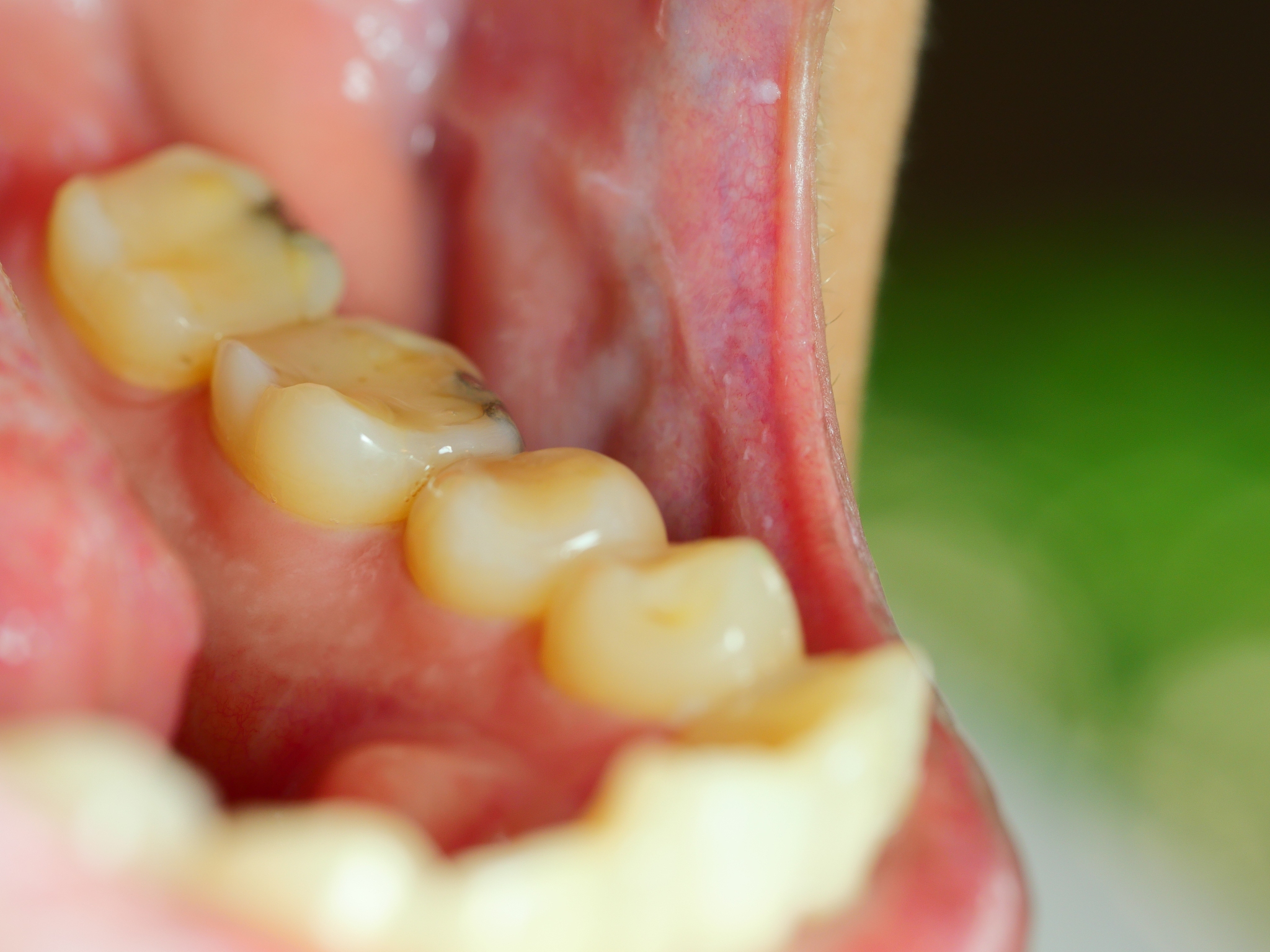 牙龈肿痛怎么处理