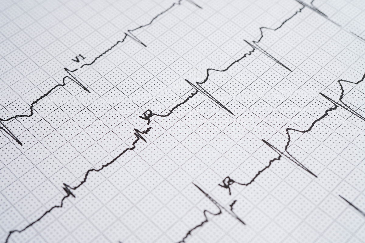 心电图ST段抬高：症状、原因及治疗