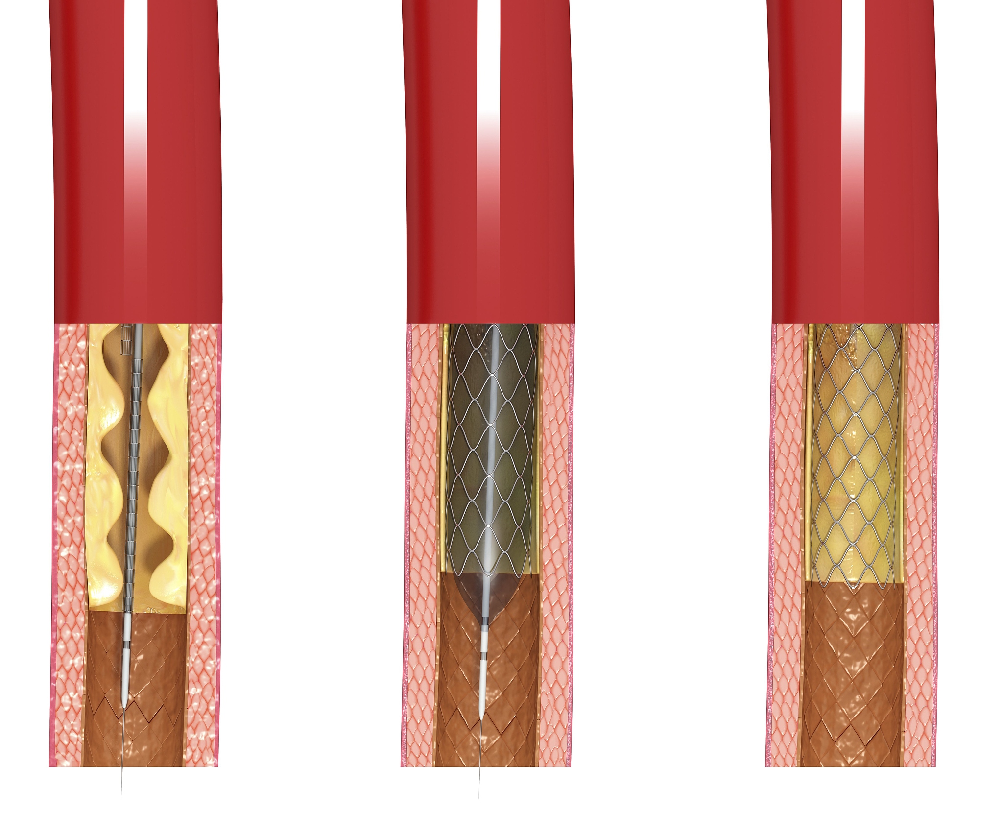 动静脉内瘘狭窄不用愁！PTA术后内瘘护理指南