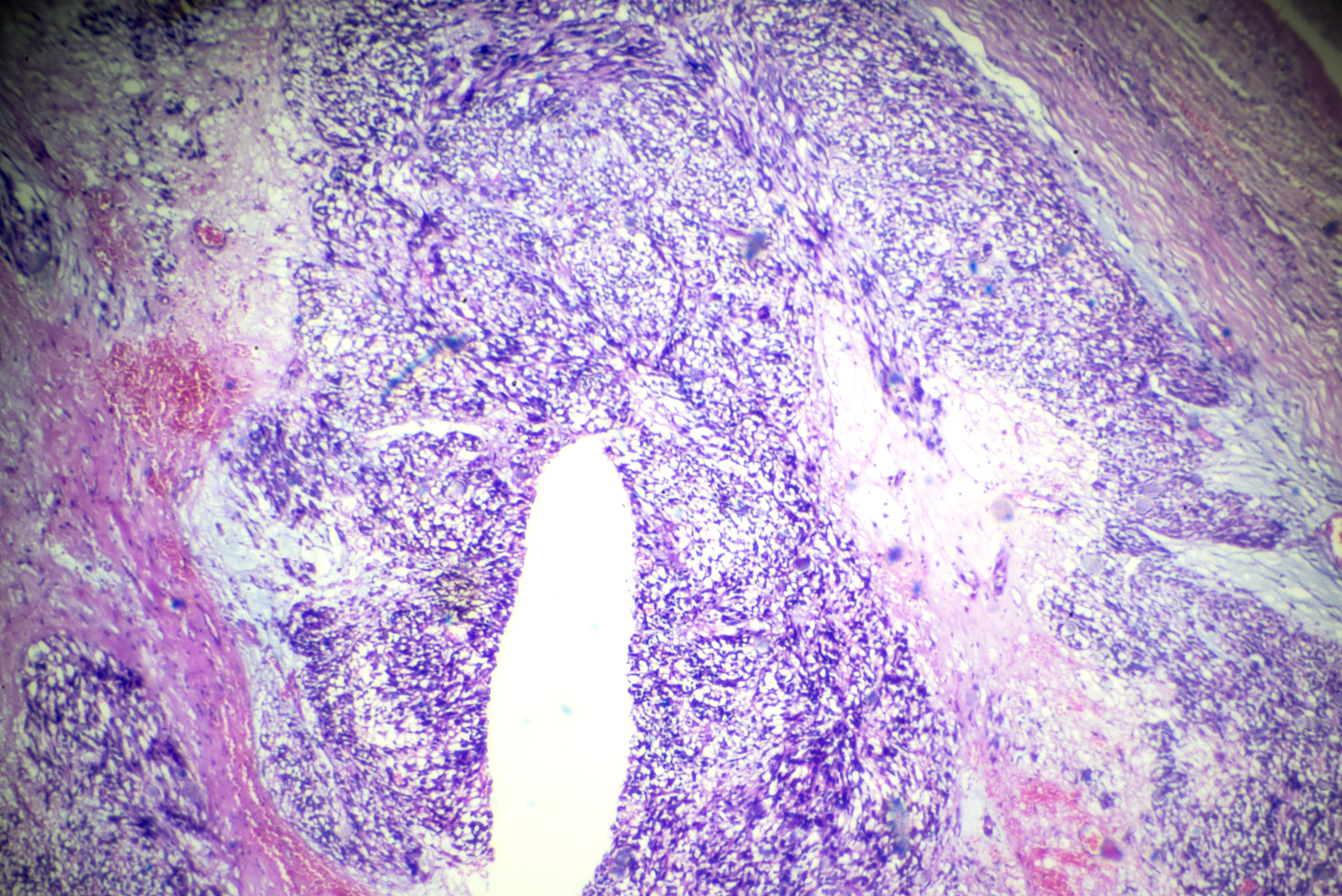 子宫平滑肌瘤护理指南：专业建议助您缓解症状