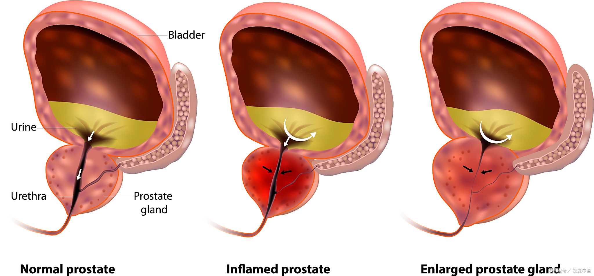 什么原因会导致前列腺炎呢？ - 其他广告 - 广告专区 - 拉萨分类信息 - 拉萨28生活网 lasa.28life.com