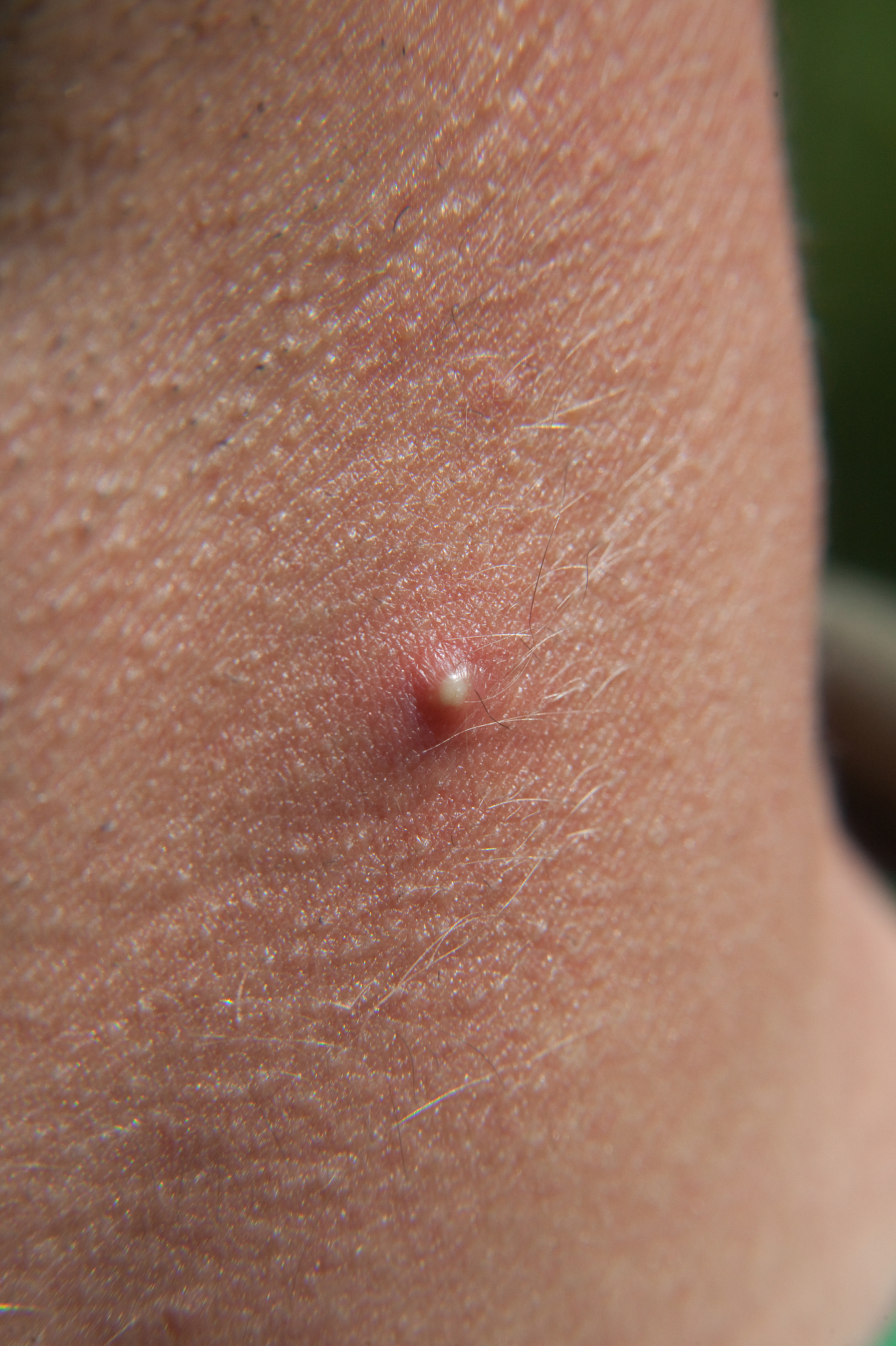 huge acne spot or pimple on a mans neck