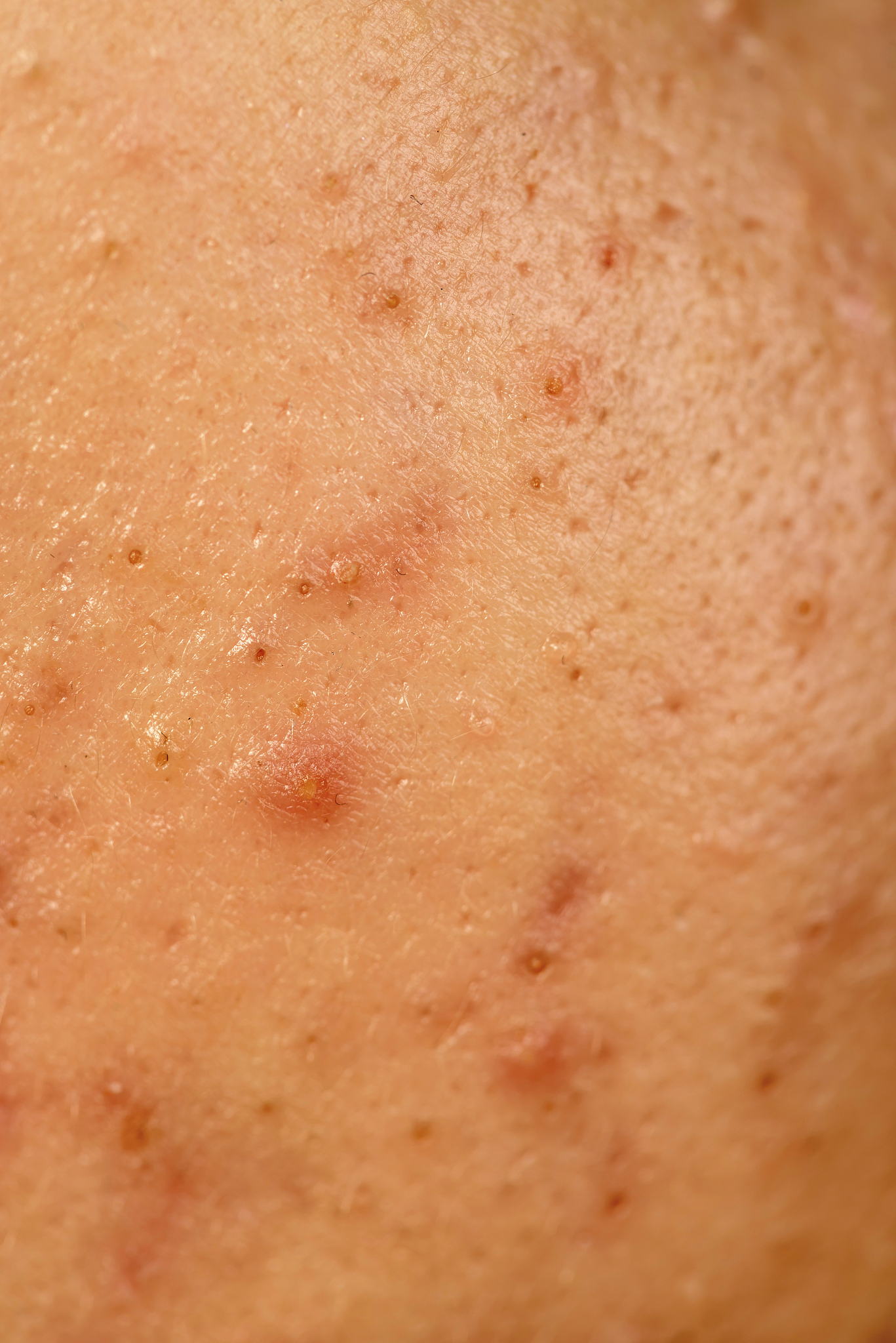 problematic skin
