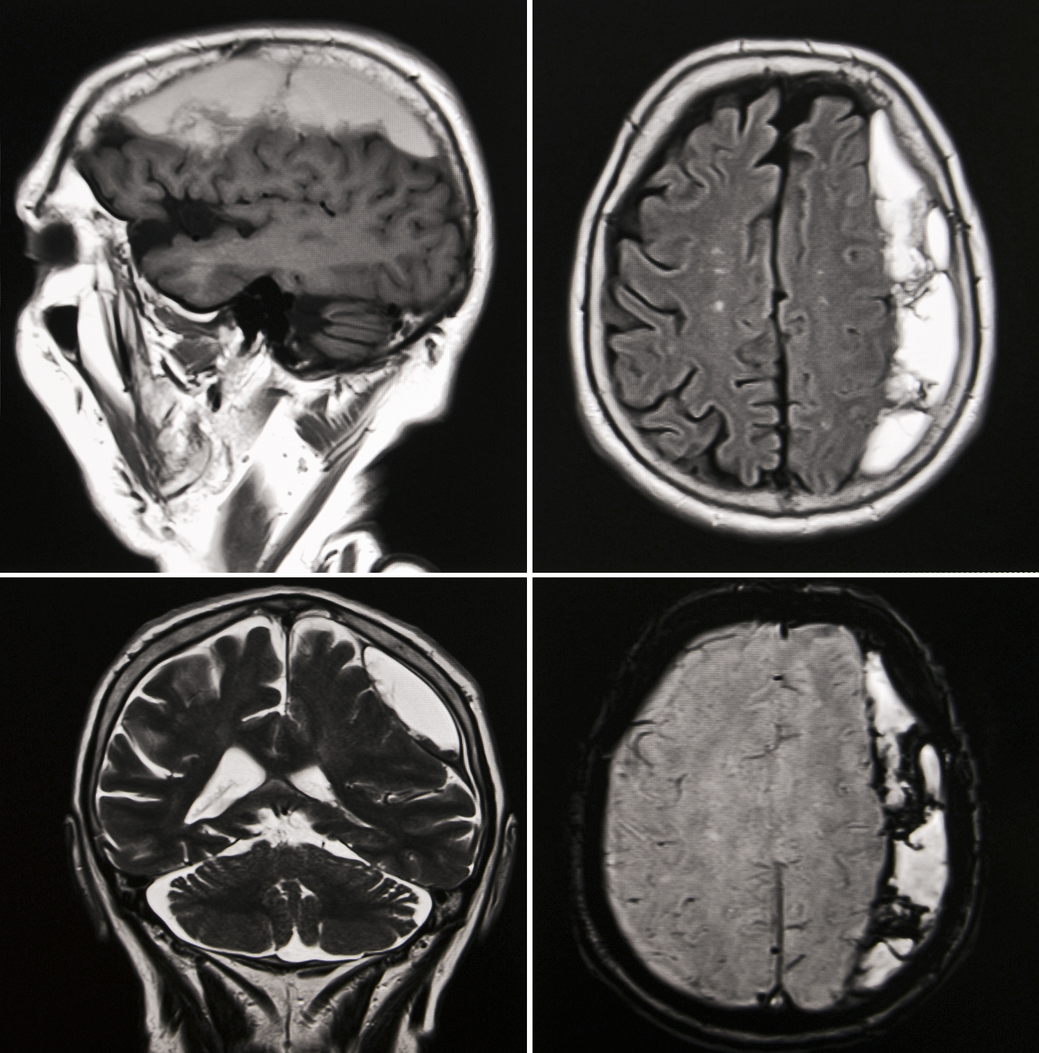 右侧尾状核头腔隙性脑梗死与神经精神症状的相关性：MRI 验证