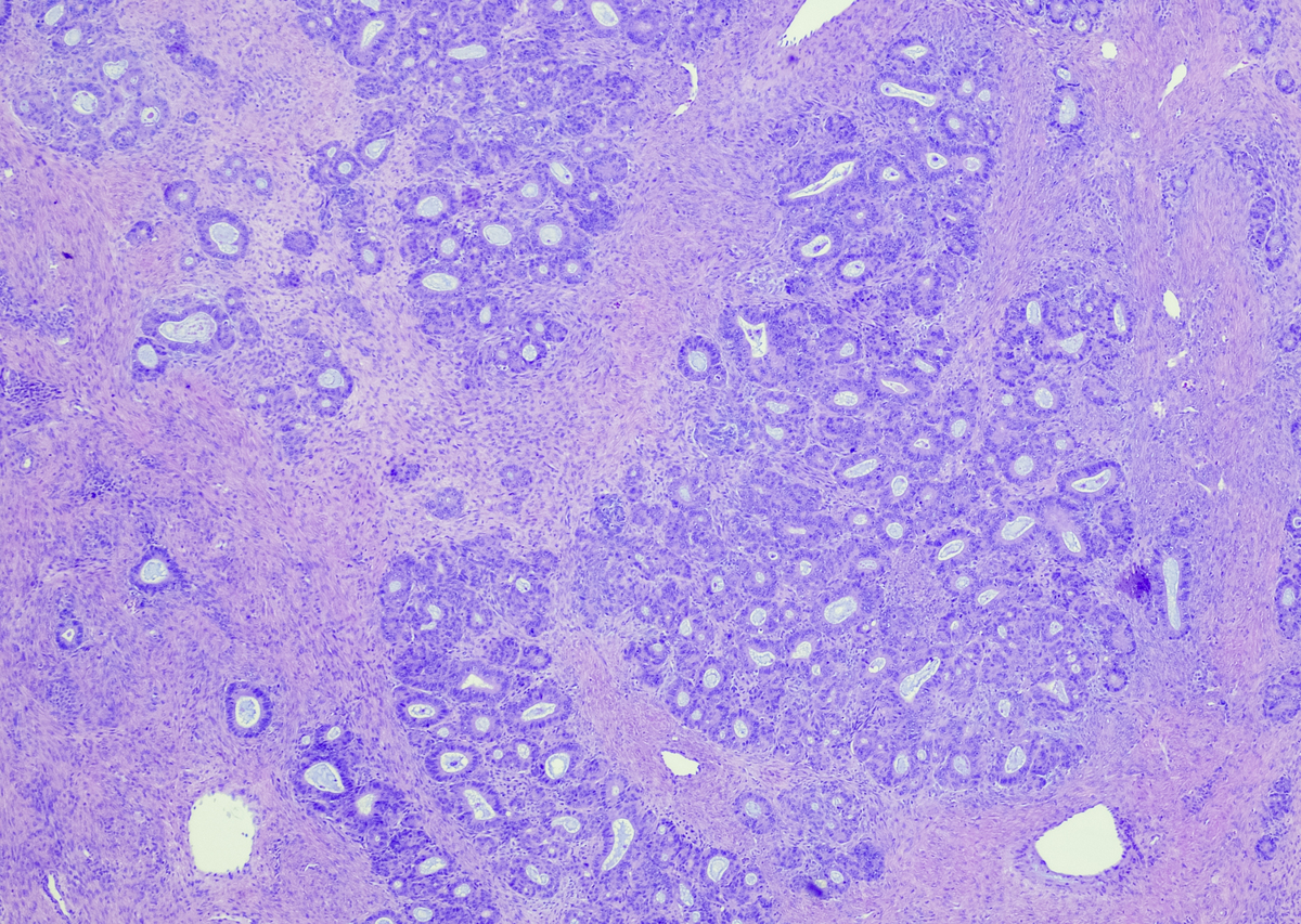 翻译一下：At first it attacks any cell of the cervix then it spreads to other cells It is one of the most malignant and critical cancers throughout the world Many lives have been falling for this deadly di