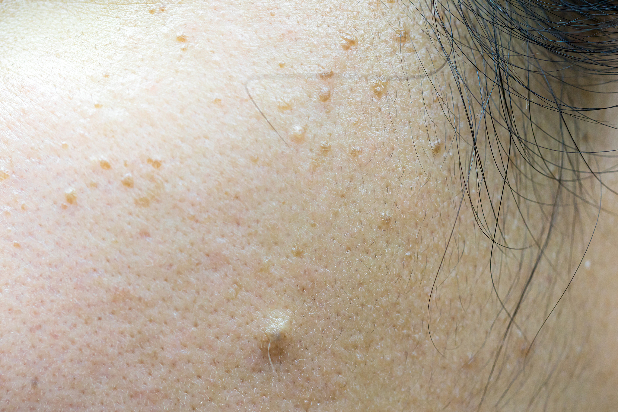 脸上有螨虫？有效治疗方法及注意事项