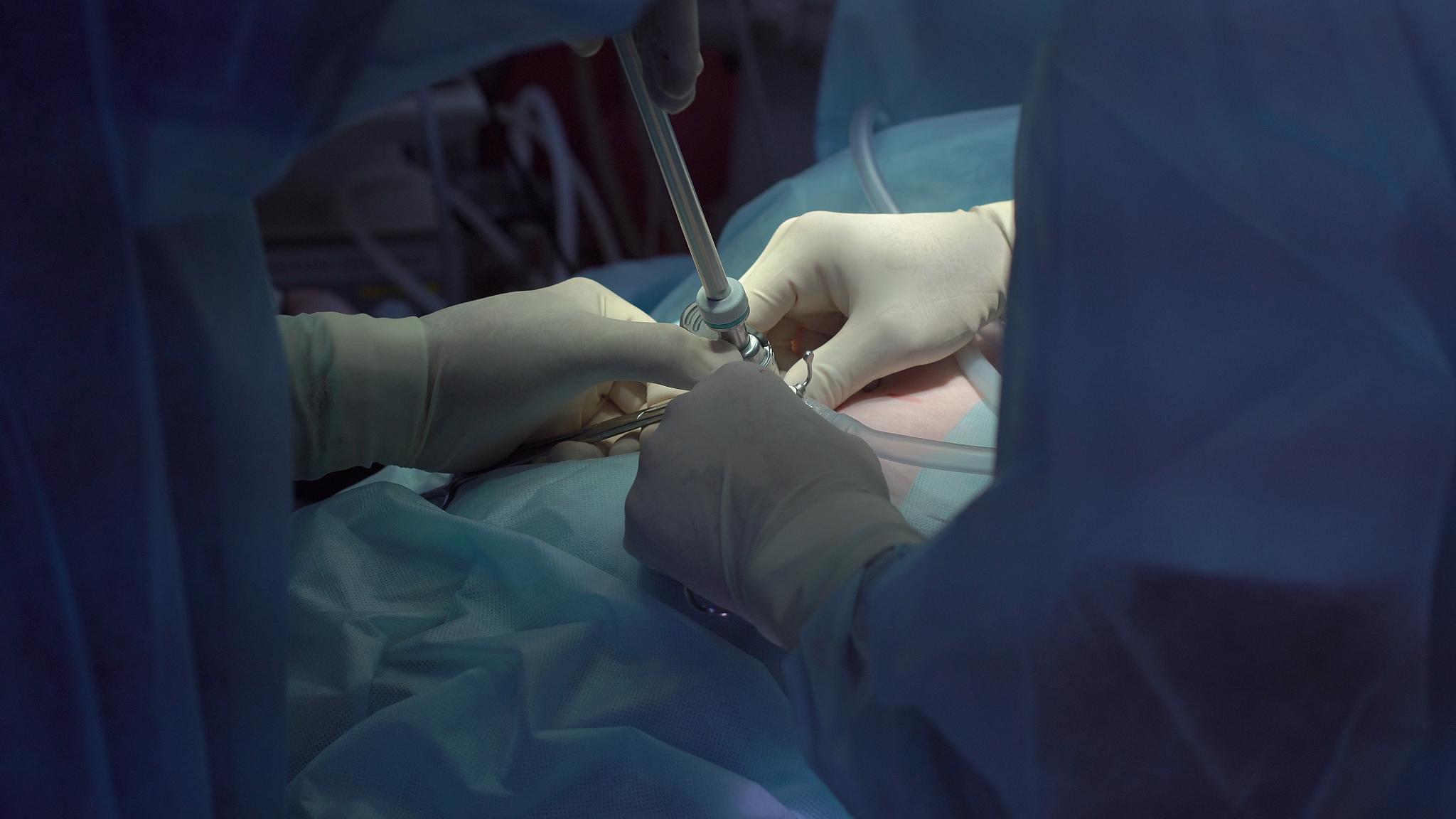 operation using laparoscopic equipment. surgeons team. hospital