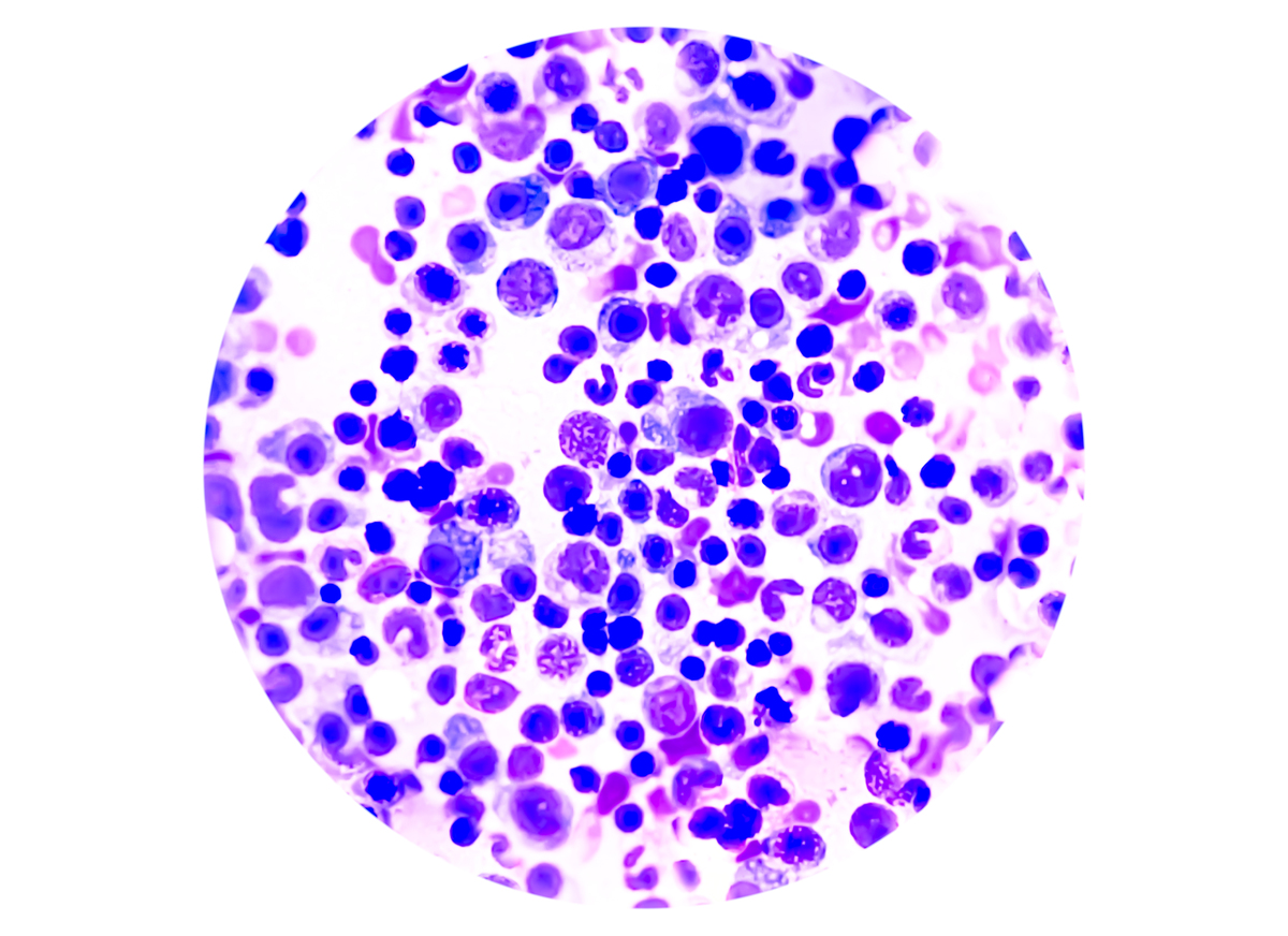 血涂片中不容易看到血小板的原因是什么