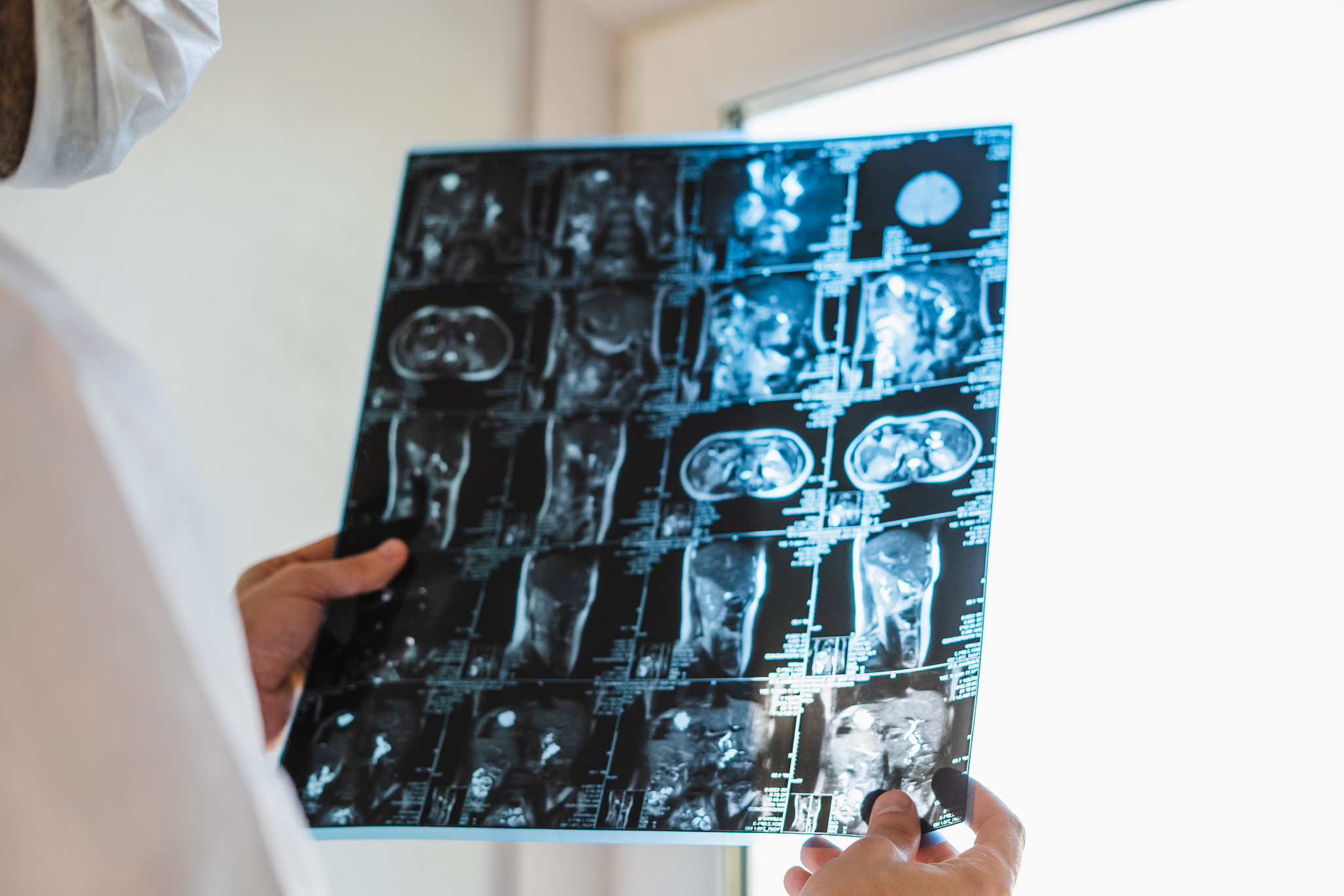 医学图像分割在医学研究、病情诊断、病情分析、手术辅助等方面都具有广泛的应用和研究价值而医疗图像分割是决定医学图像是否为医学诊断提供可靠依据的中心问题。根据医学图像的某些相似性特征如亮度、颜色、纹理、面积、形状、位置、局部统计特征或光谱特征将医学图像划分为数千个不相交的连接区域的过程称为分割。相关特征在同一区域内表现出一致性或相似性而在不同区域间表现出明显的不同即在区域边界上的像素存在某种不连续性1