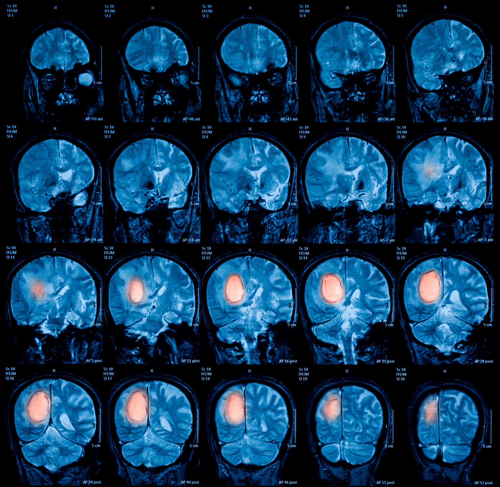 脑血管畸形：病因、症状、生活管理 - 全面解析
