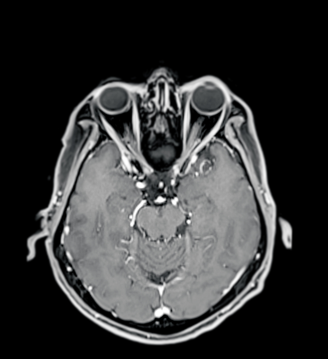 腺泡样软组织肉瘤的CT、MR影像学特征分析：文献综述