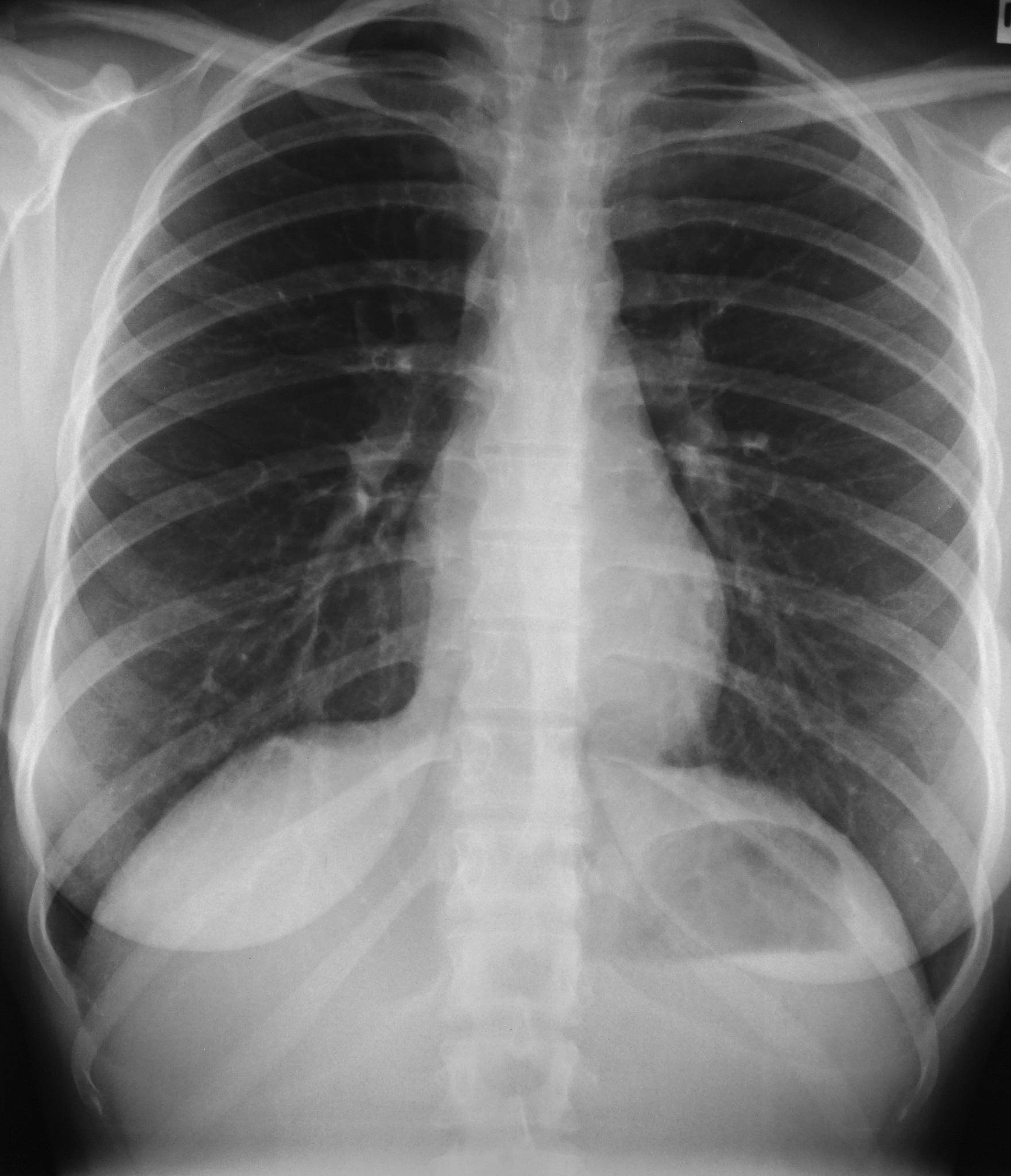 慢性阻塞性肺病合并急性下呼吸道感染的感染护理