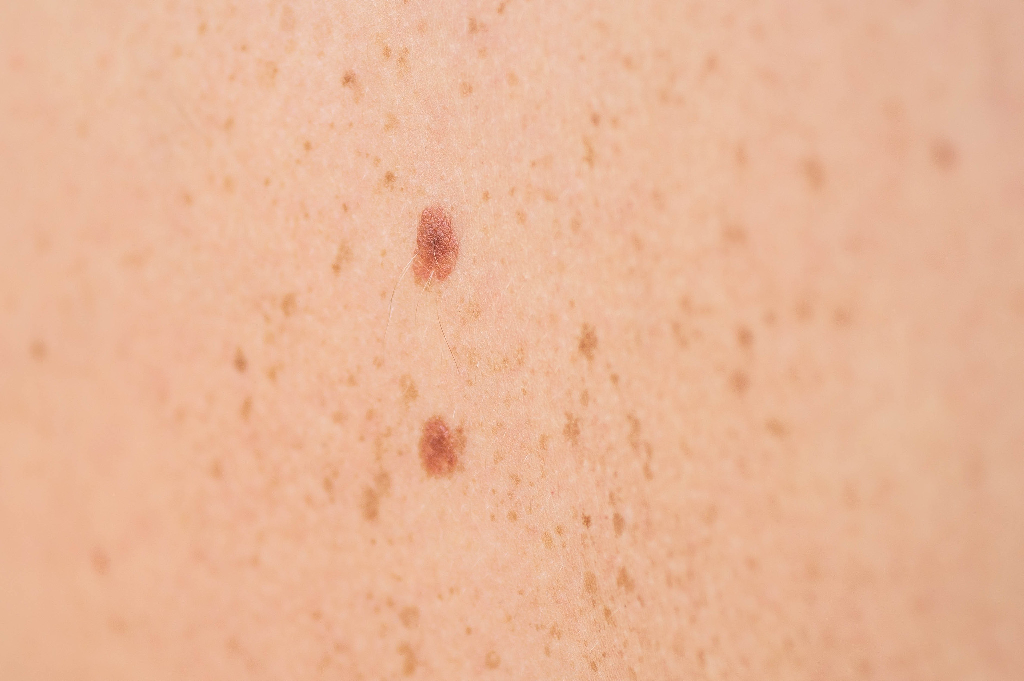 close up detail of the bare skin on a man back with scattered mo