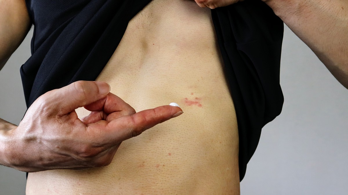 肋骨附近有疤痕？巧妙应对他人询问，无需尴尬！