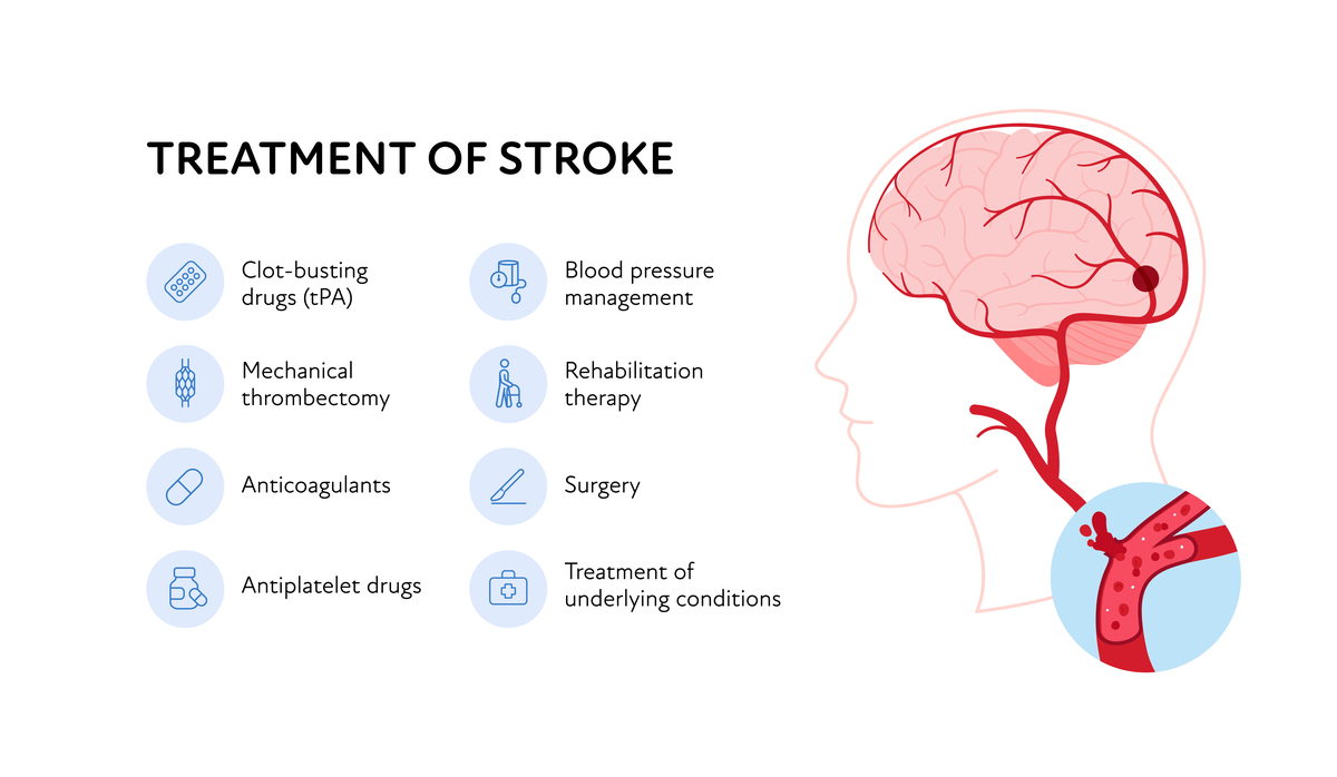 中风：症状、原因及治疗