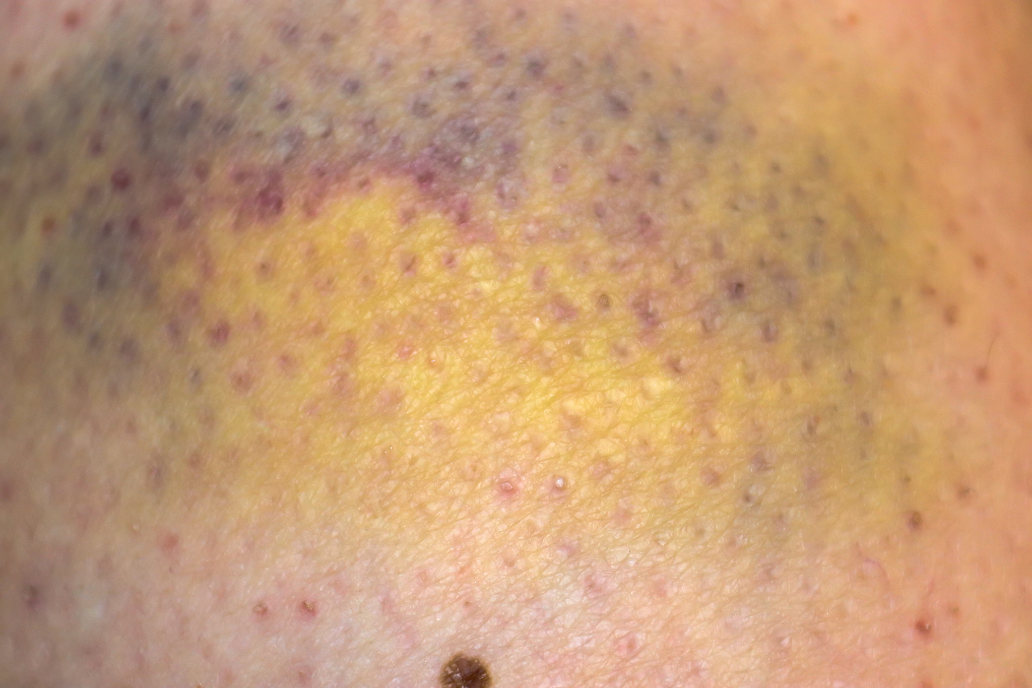 large bruise hematoma on the humans leg on the skin in different