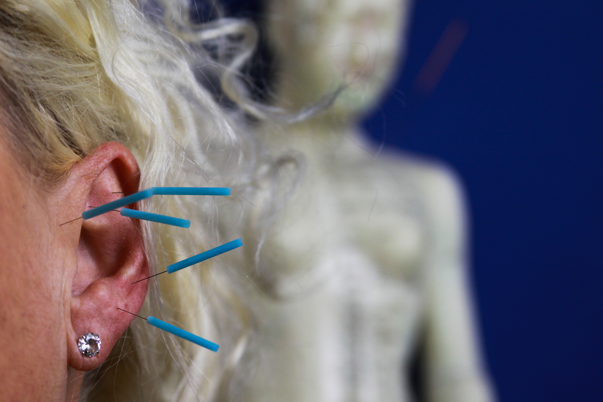 close-up of woman getting treatment from acupuncture needles