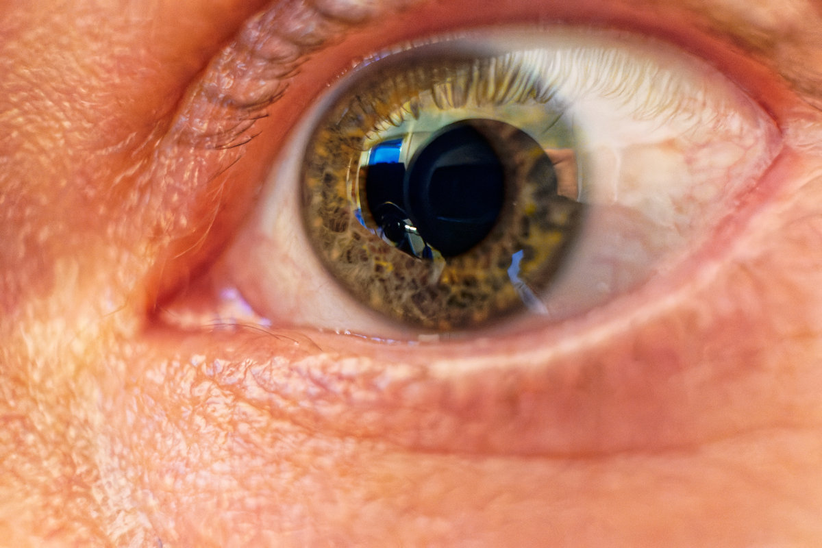 真菌性角膜炎的临床特征中关于视力下降的具体说明至少300字