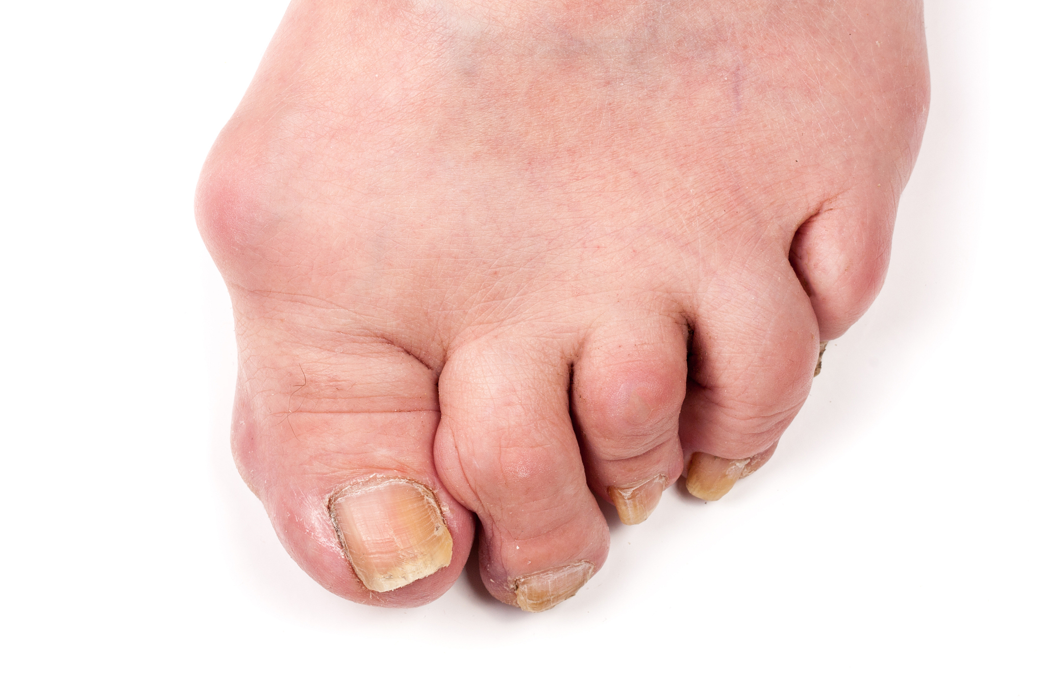 SpA 疾病：症状、治疗和管理 - 详细解读