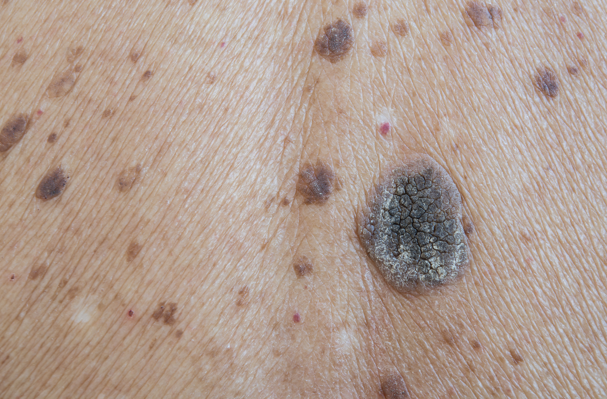 freckles on the skin