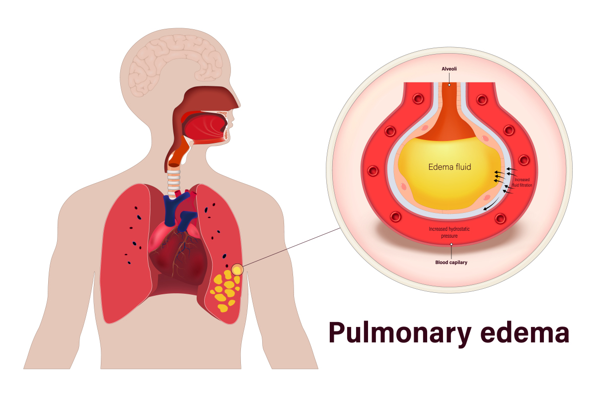肺癌病人有痰排不出来怎么办