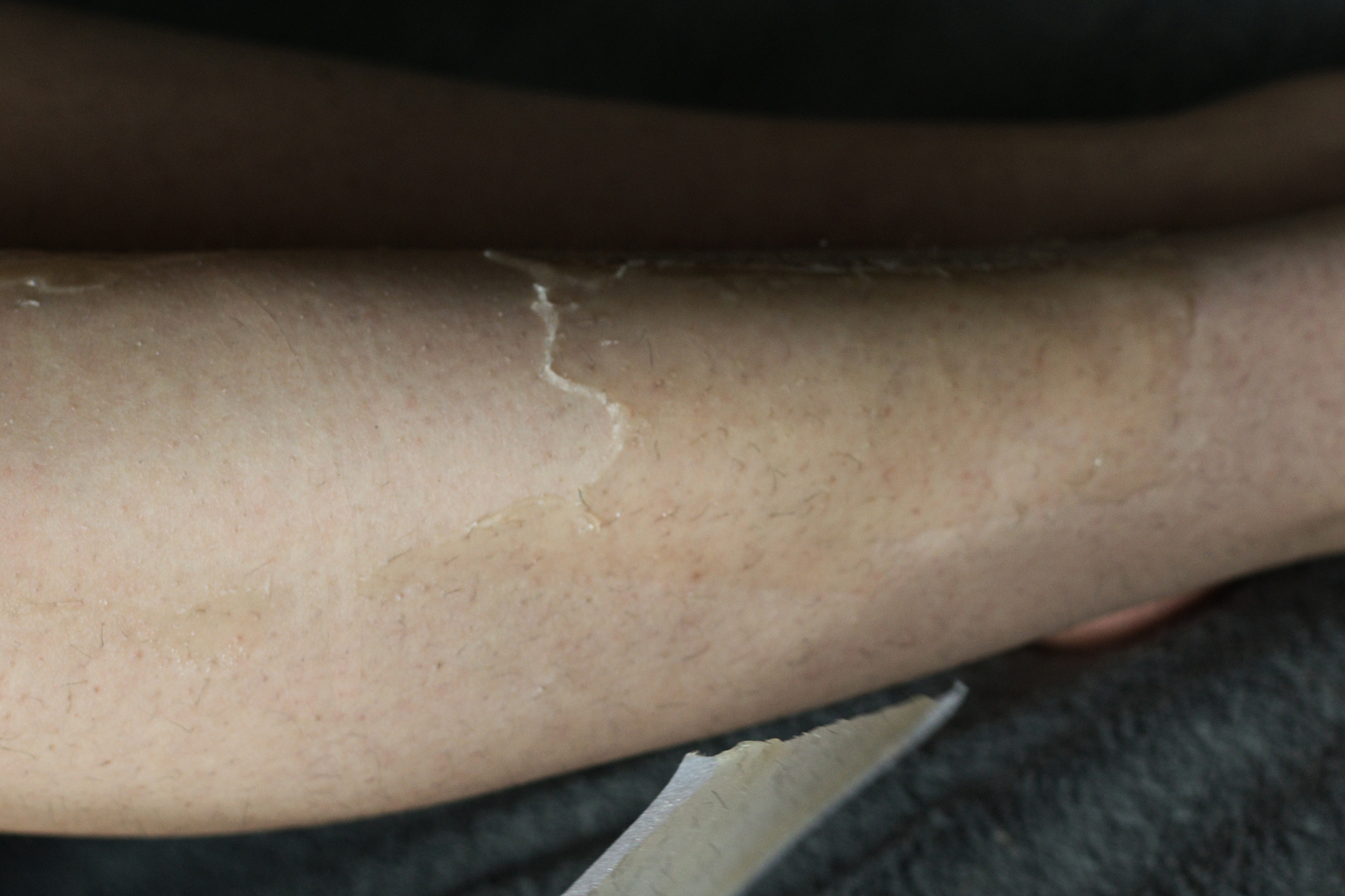 阴毛可以永久去除吗