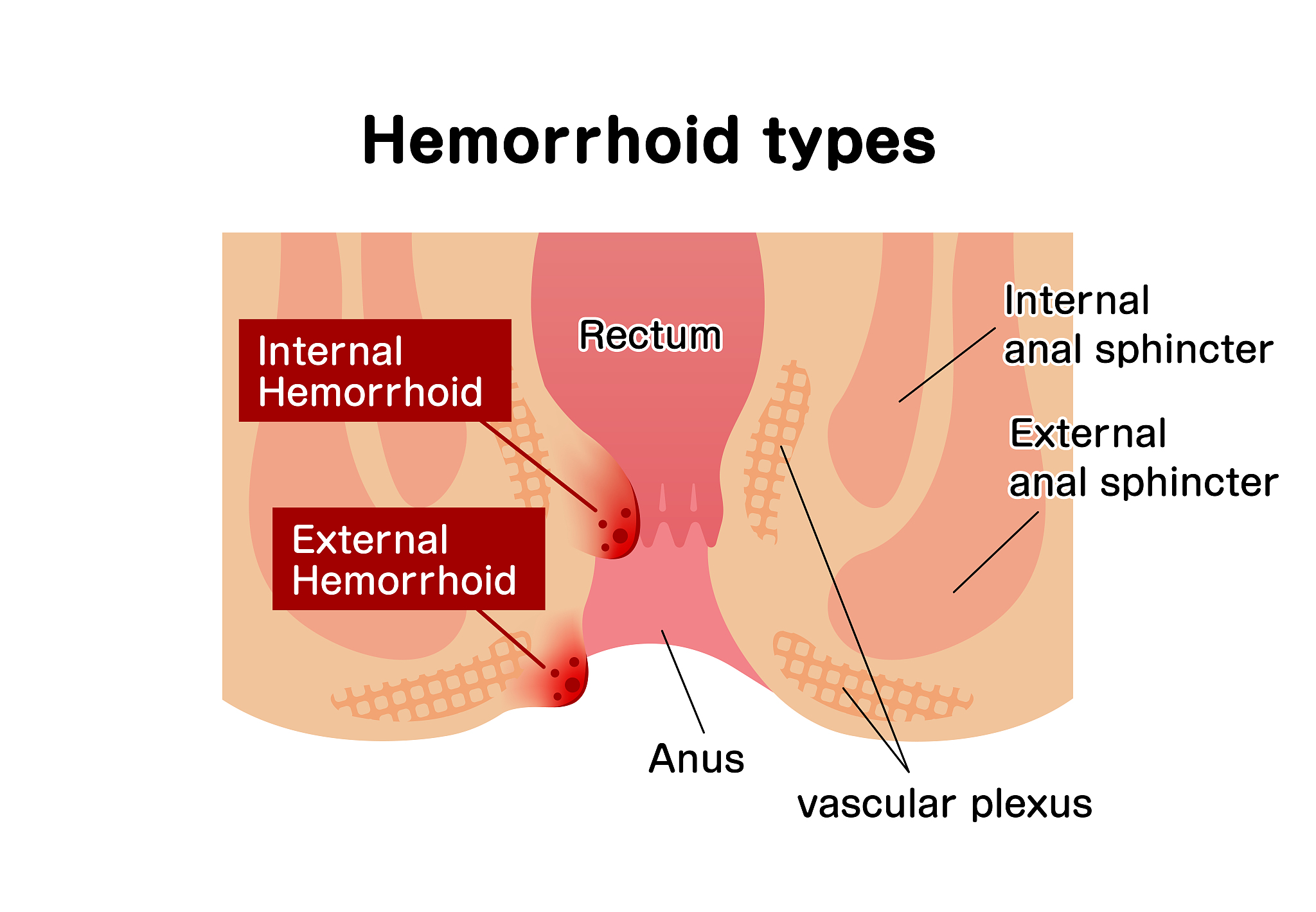 types of hemorrhoid flat vector illustration