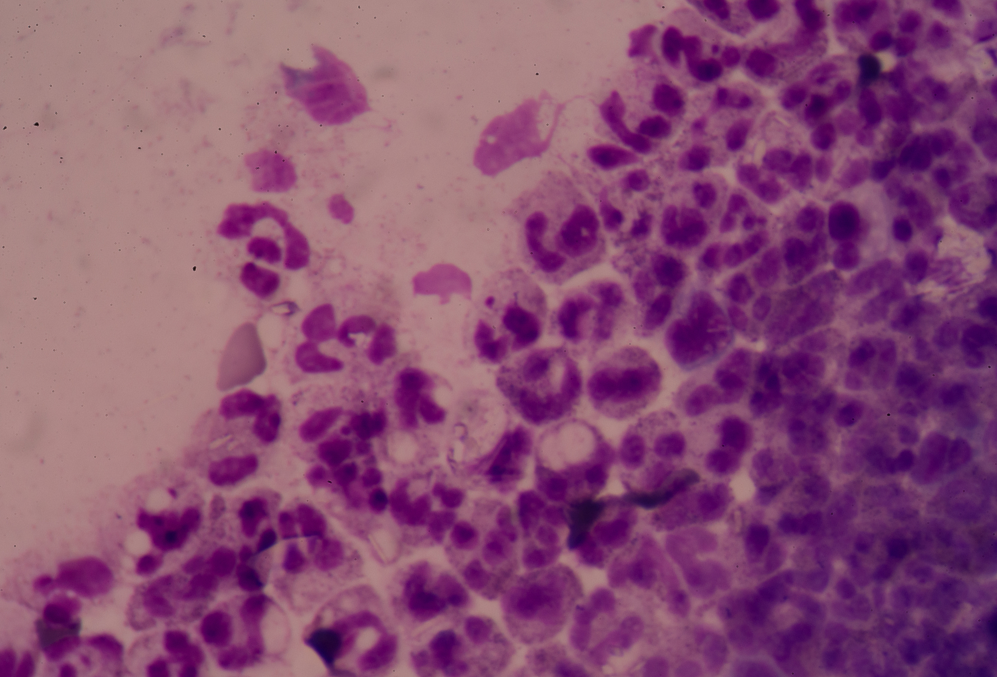 巨噬细胞在MDA5皮肌炎性间质性肺炎中的作用及铁死亡机制研究