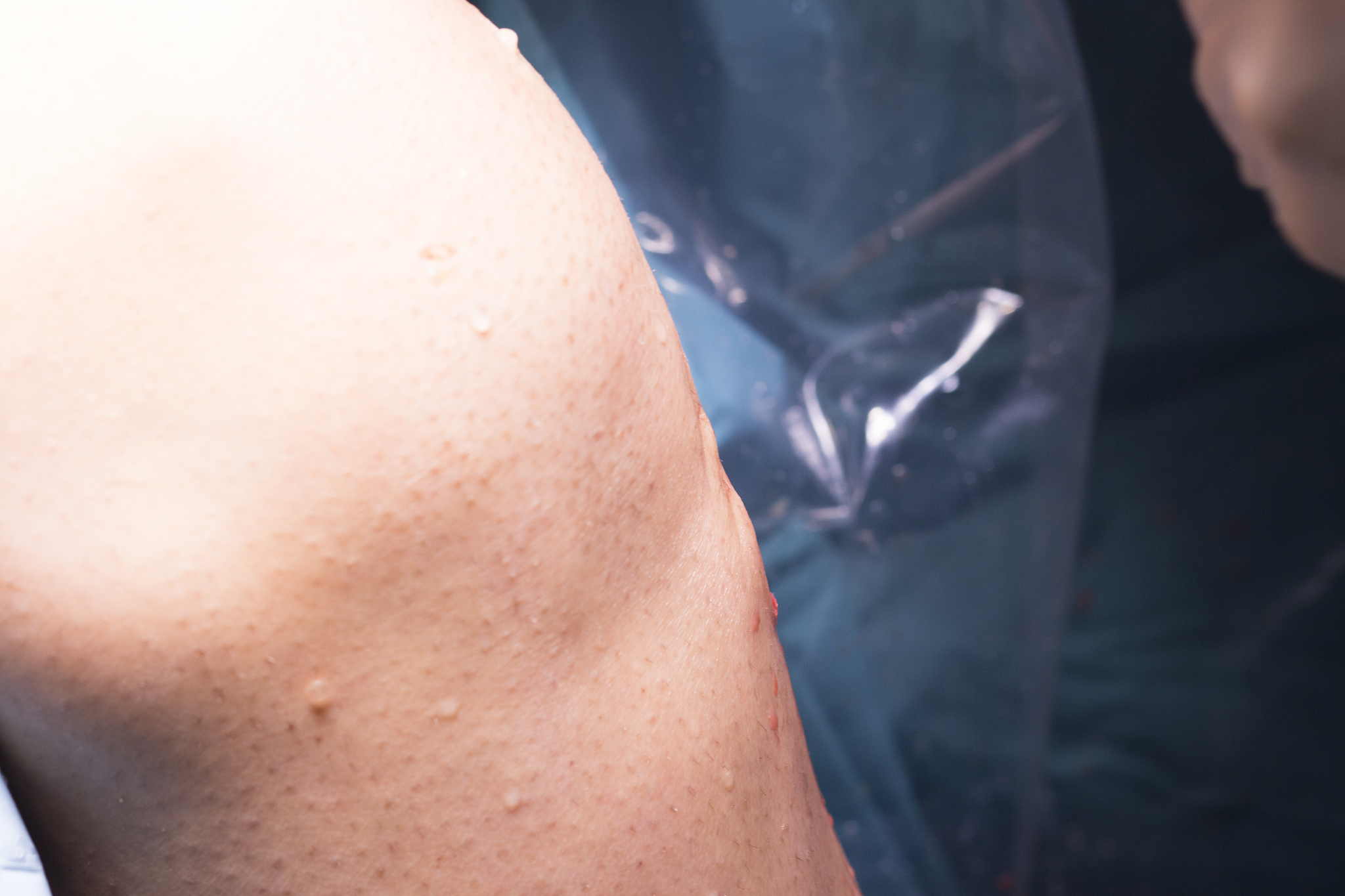 surgical operation knee arthroscopy micro surgery in hospital op