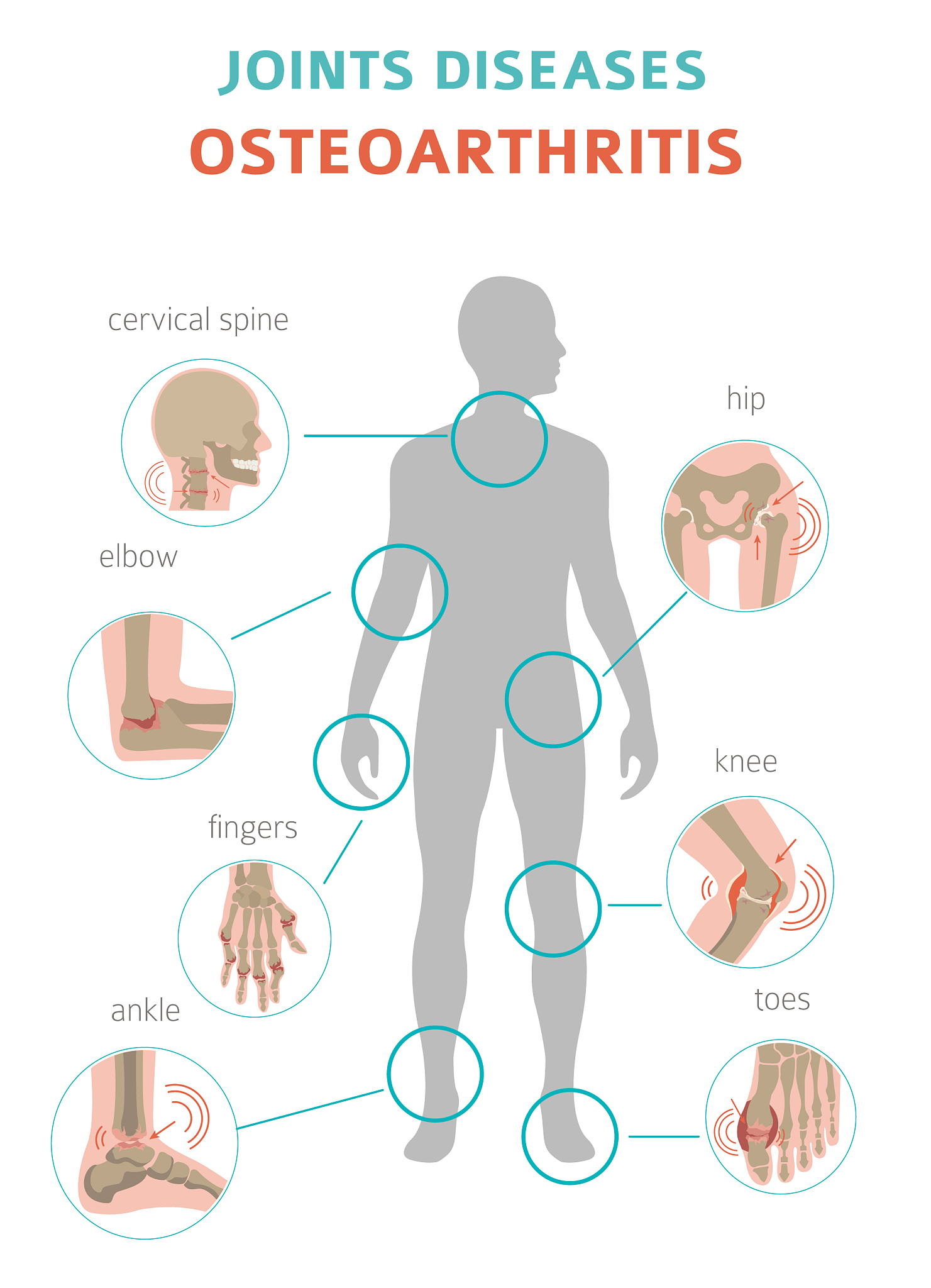 Osteoarthritis: Causes, Symptoms, Treatment & Management