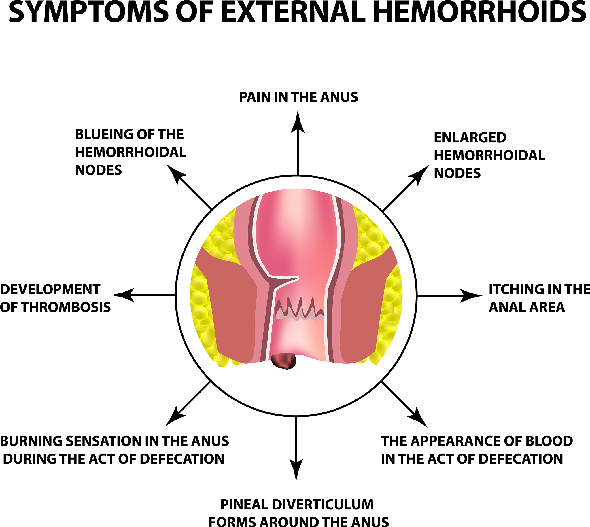 symptoms of external hemorrhoids