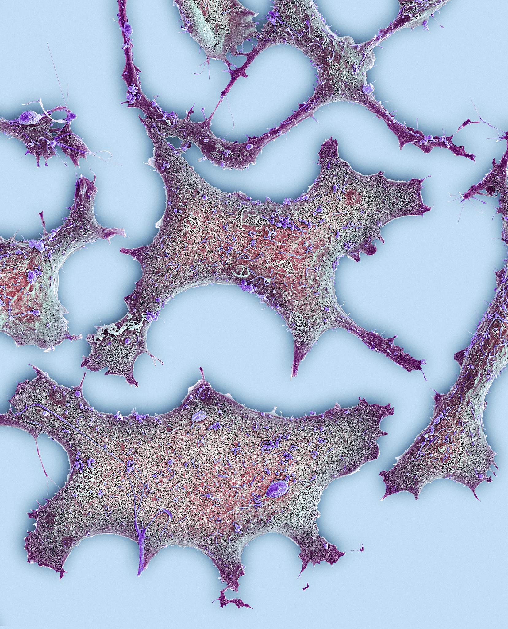 3级低分化是什么意思？